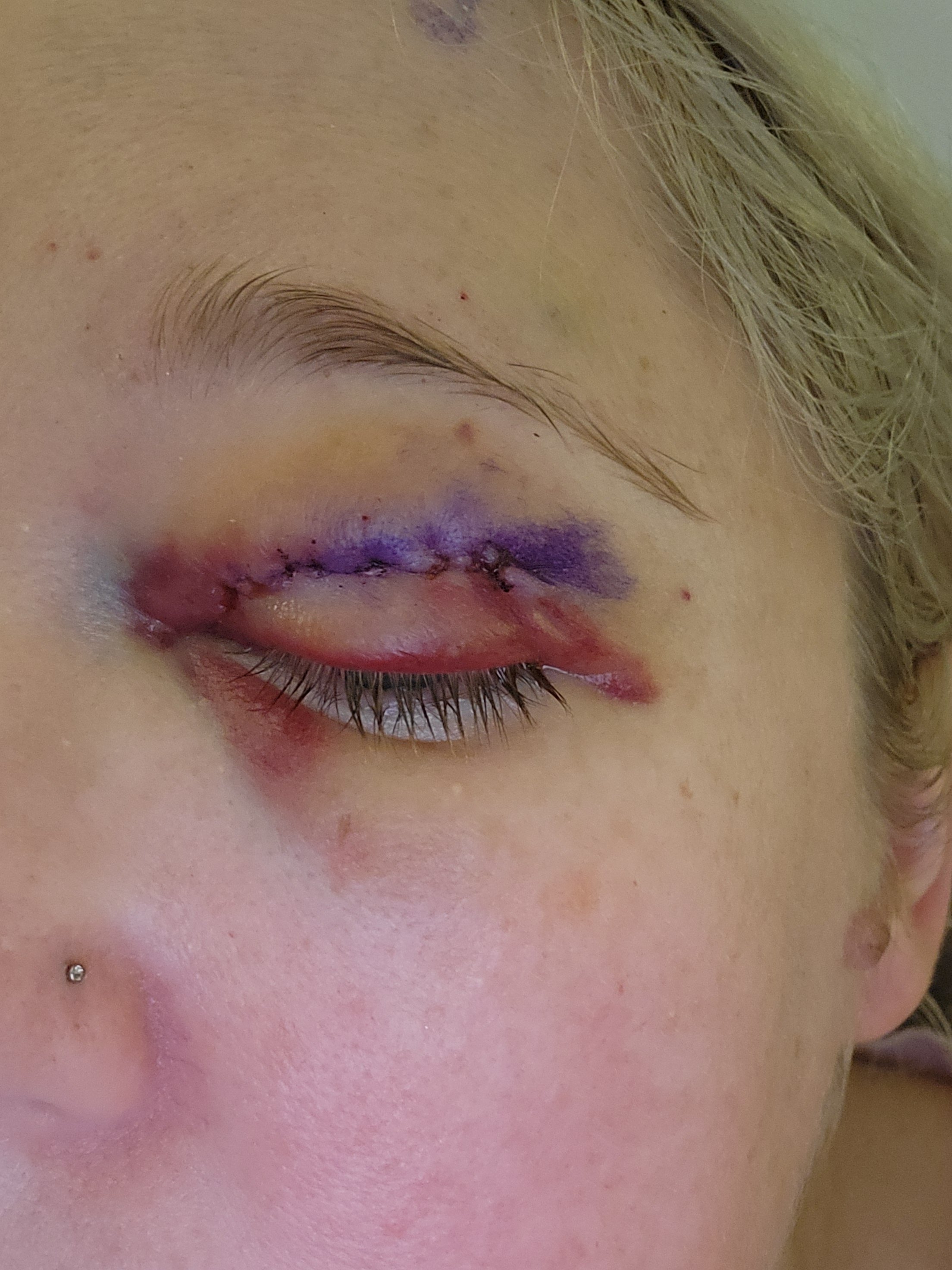 Life Changing Nerve Surgery - One Year Update campaign photo, 6 of 7