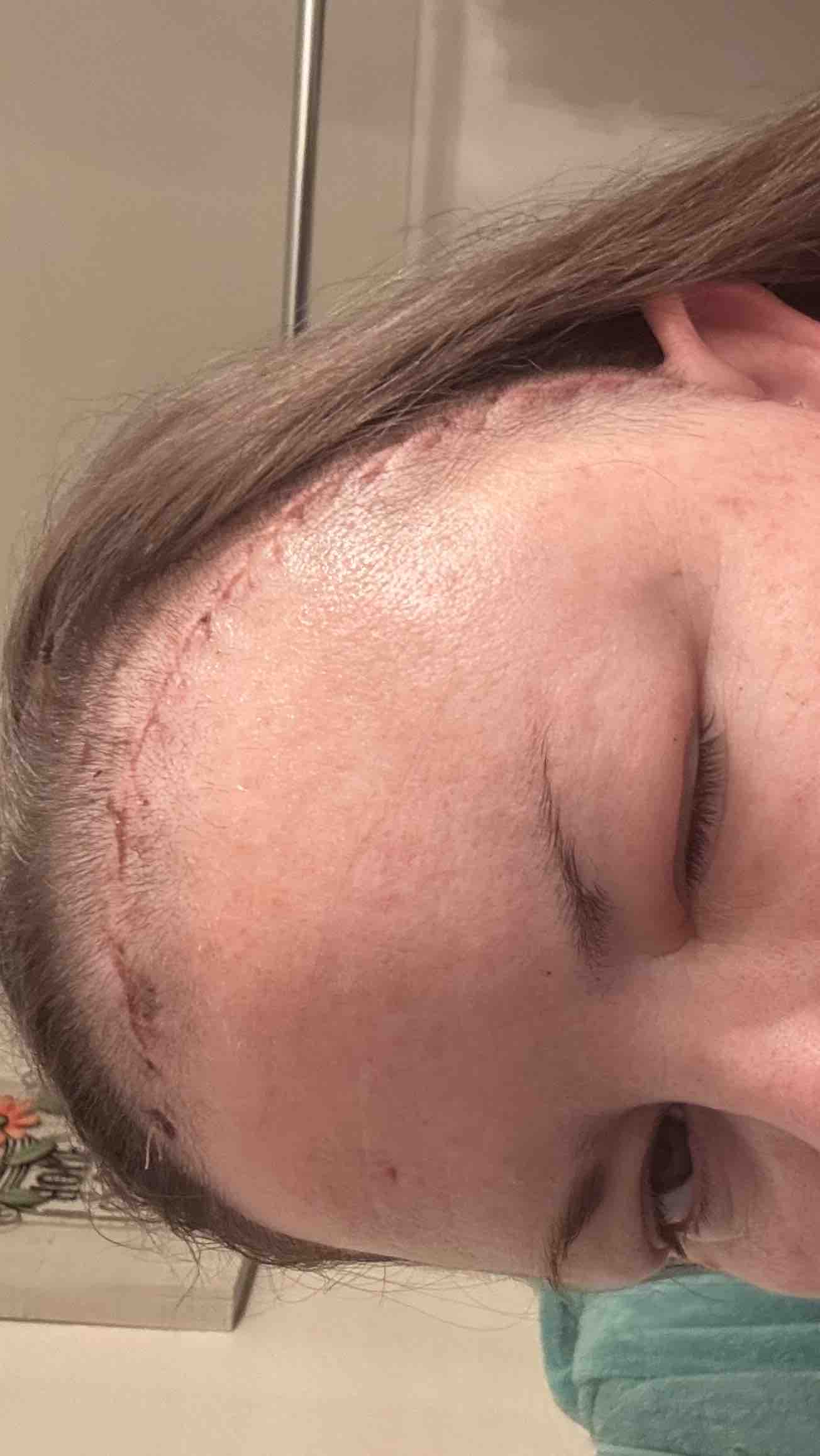 Brain Tumor Removal, 2 surgeries, need assistance with $. photo