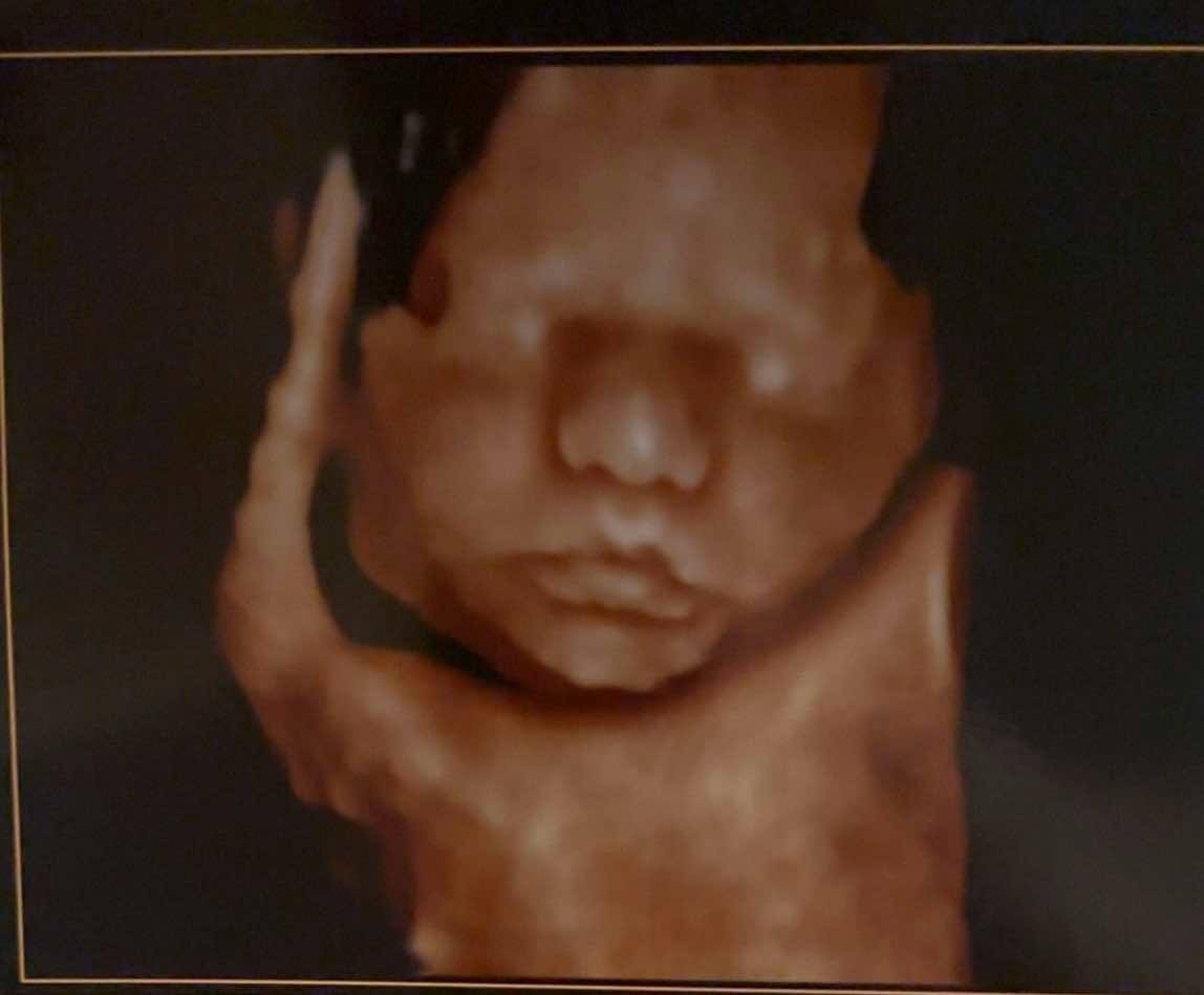 Stand with Layla in Her Fight Against CDH campaign photo, 5 of 6