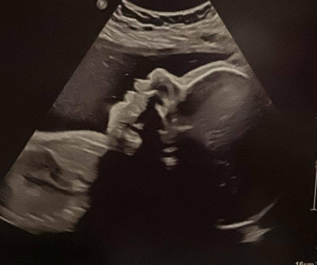 Stand with Layla in Her Fight Against CDH campaign photo, 2 of 6