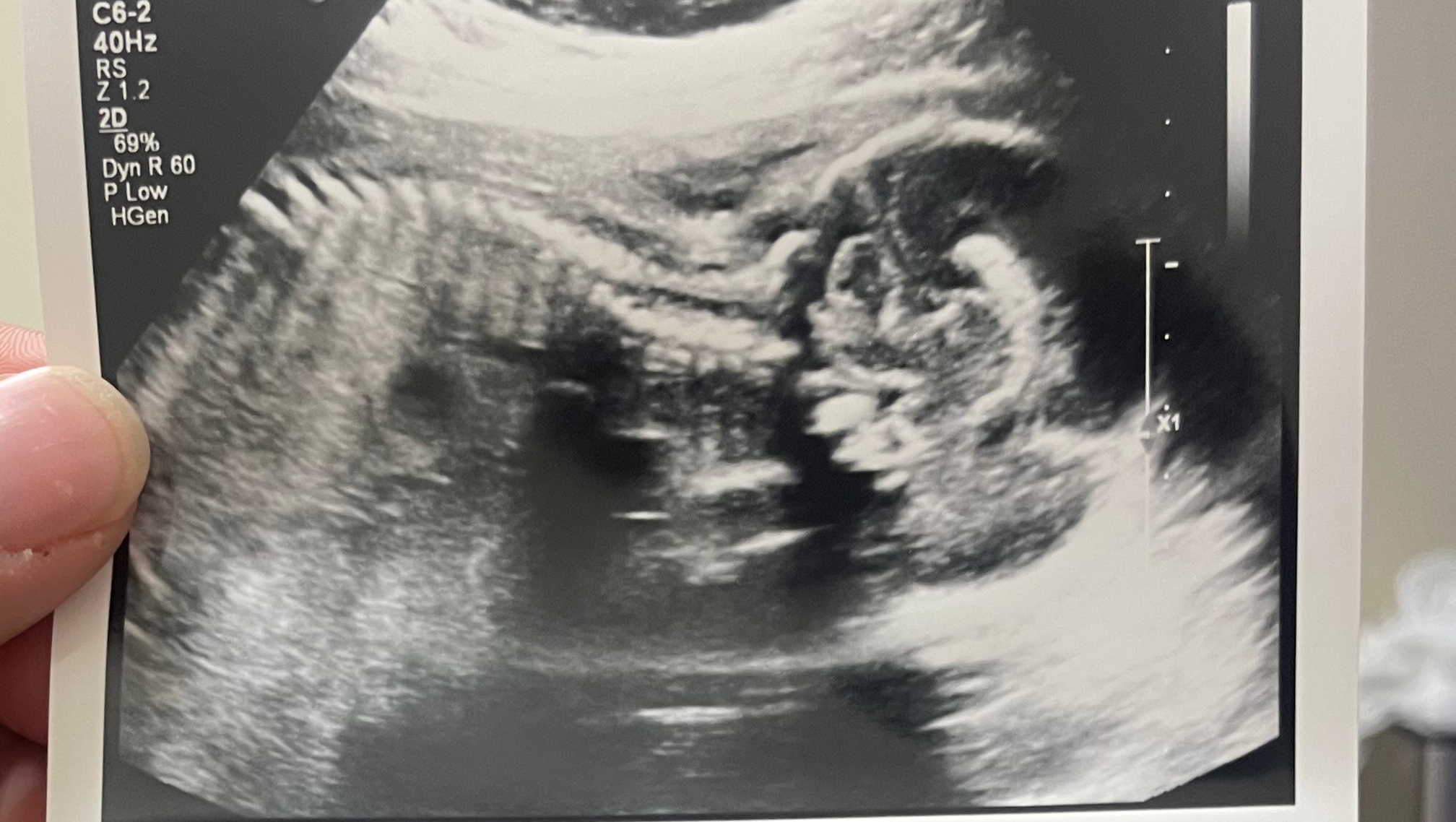 Support for Pregnancy and Newborn photo