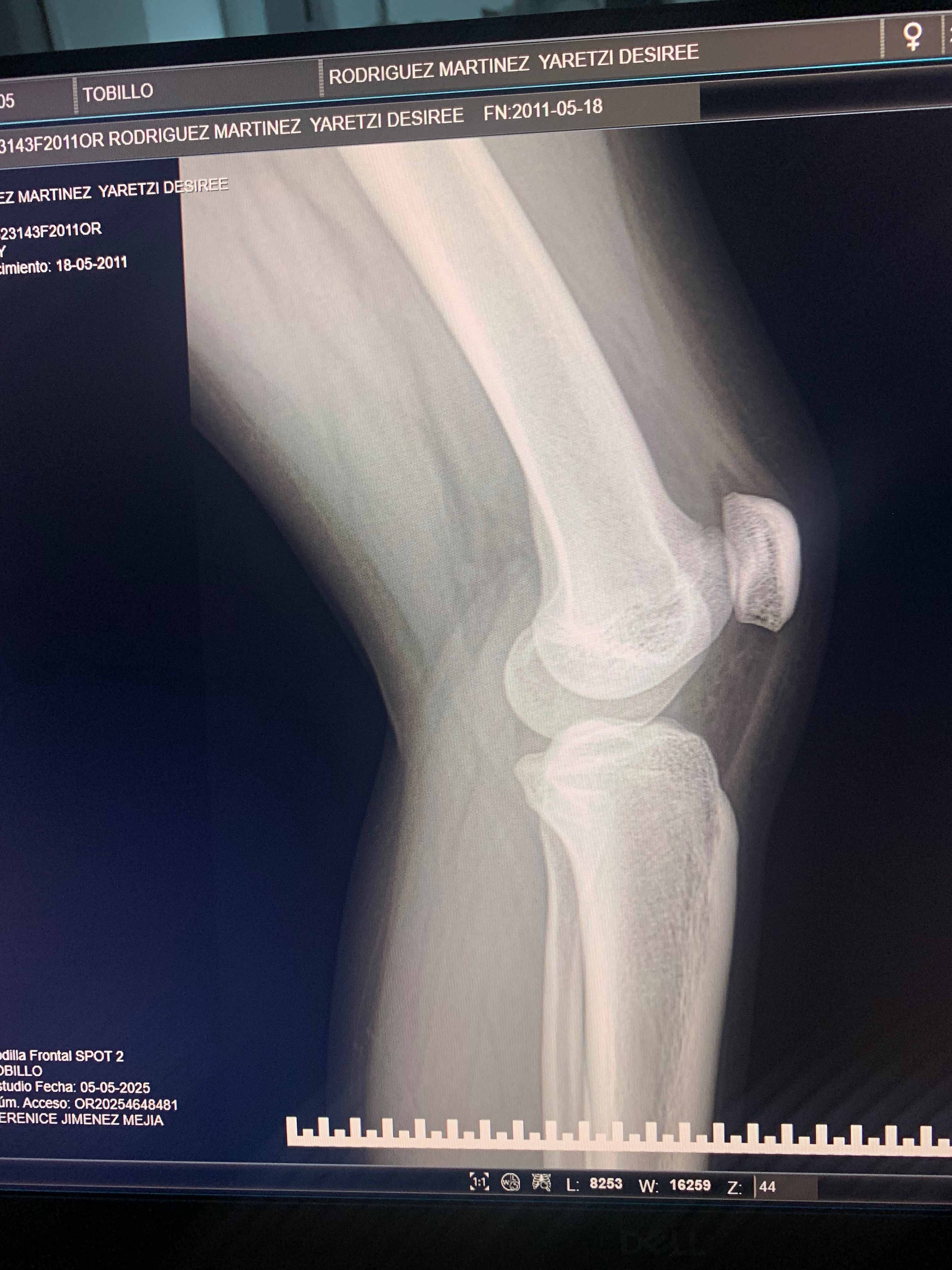 Cirugía de ligamentos y meniscos de Yare campaign photo, 4 of 6
