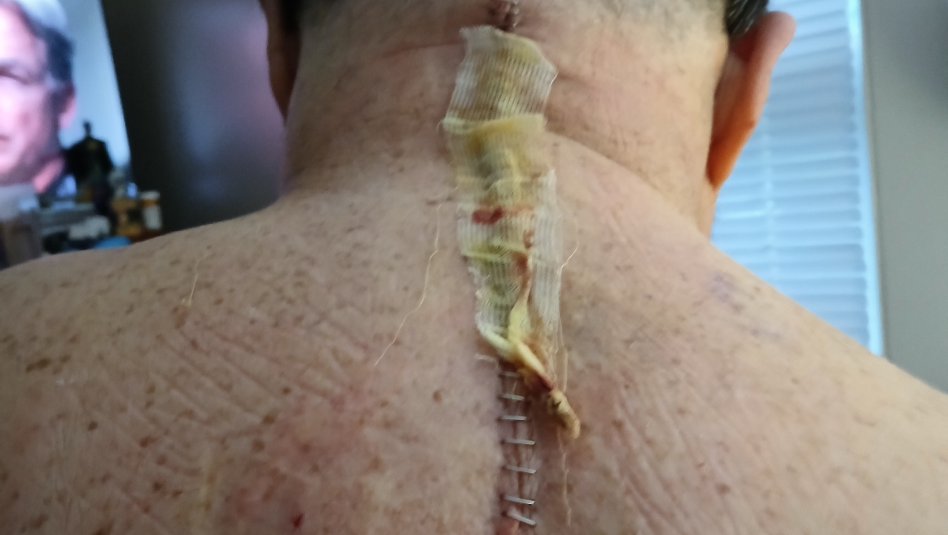 Help Julio's Journey: 6-Month Healing photo