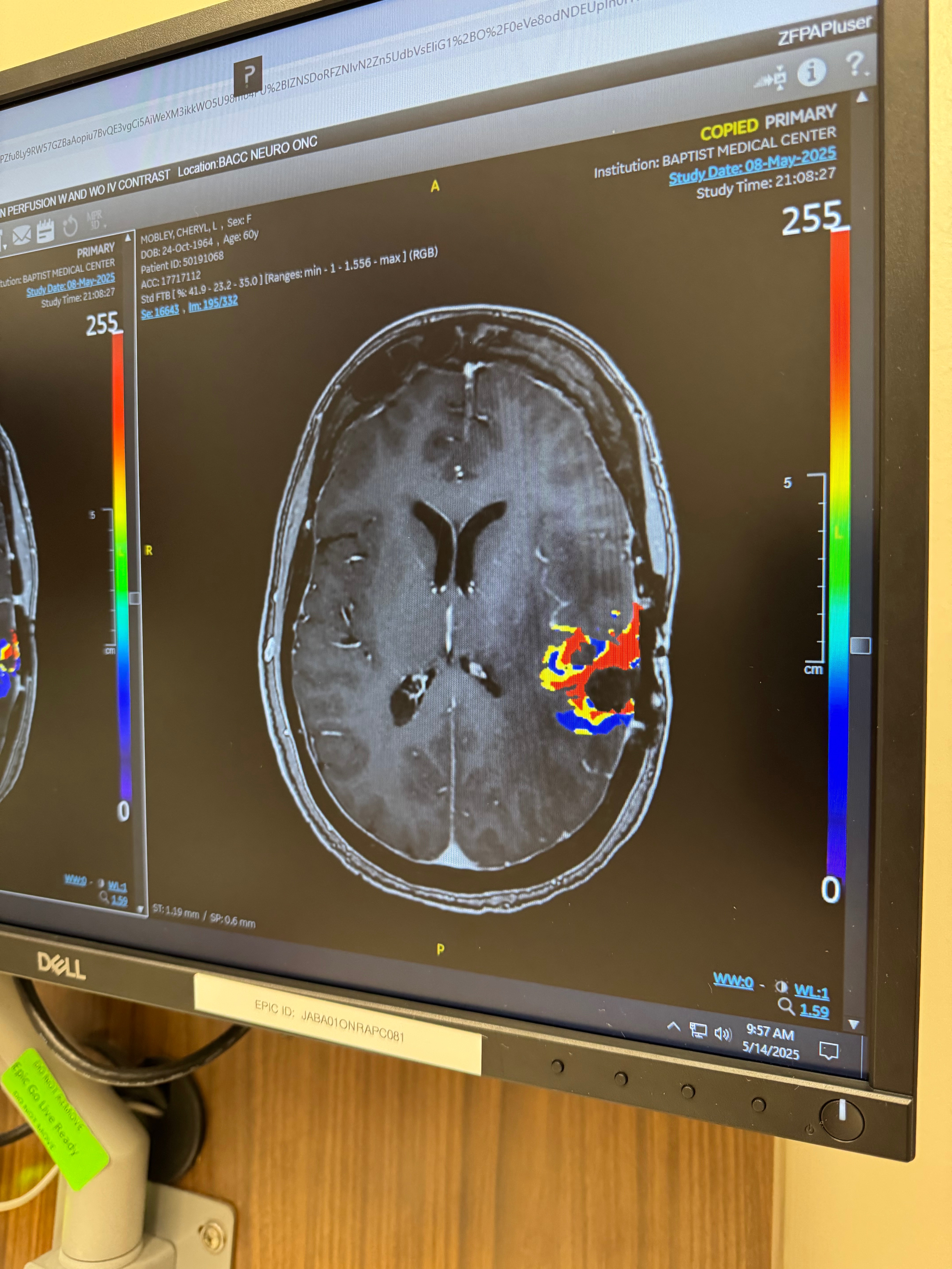 Cheryl’s Fight Against Glioblastoma campaign photo, 4 of 6