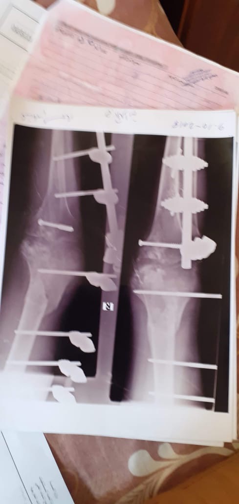 Help Adnan Walk Again campaign photo, 6 of 7