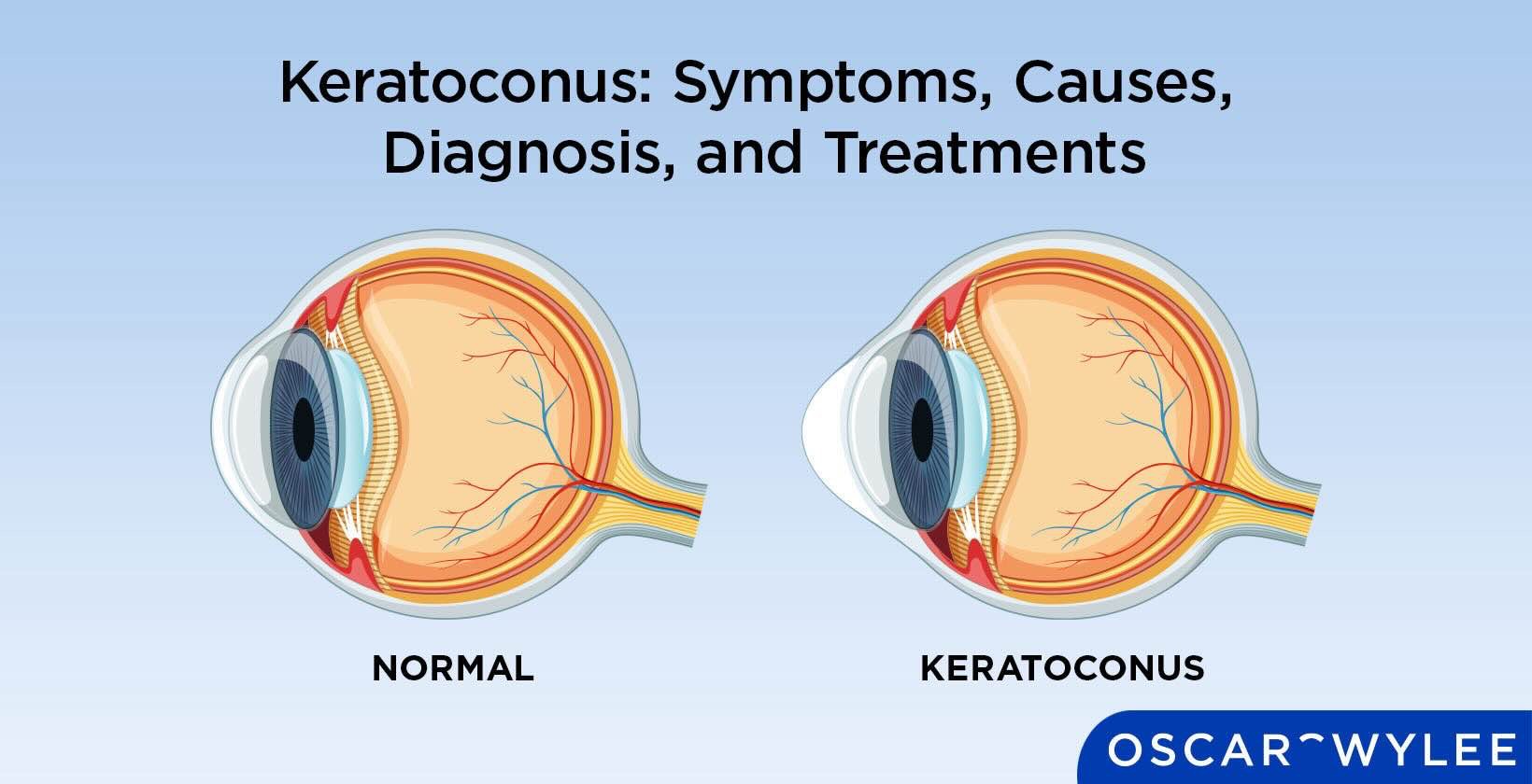 Help Save My Sight: Support for Scleral Lenses campaign photo, 5 of 6