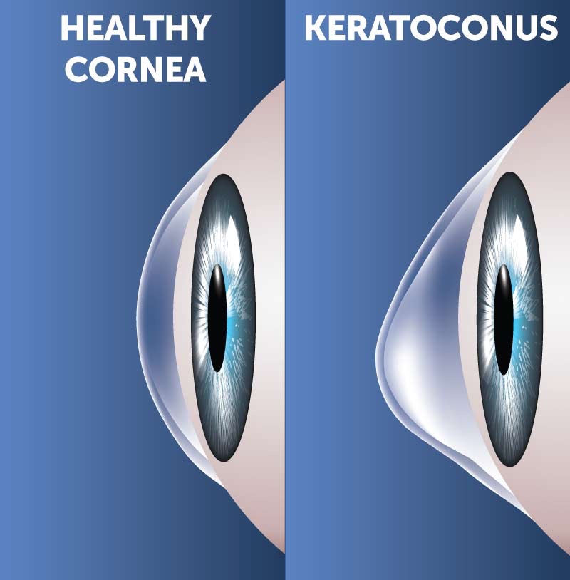 Help Save My Sight: Support for Scleral Lenses campaign photo, 2 of 6