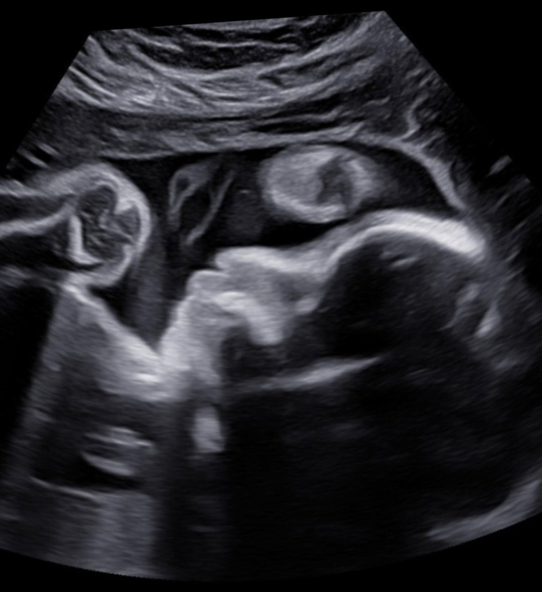 Help Us During A High Risk Pregnancy and NICU Journey campaign photo, 4 of 8
