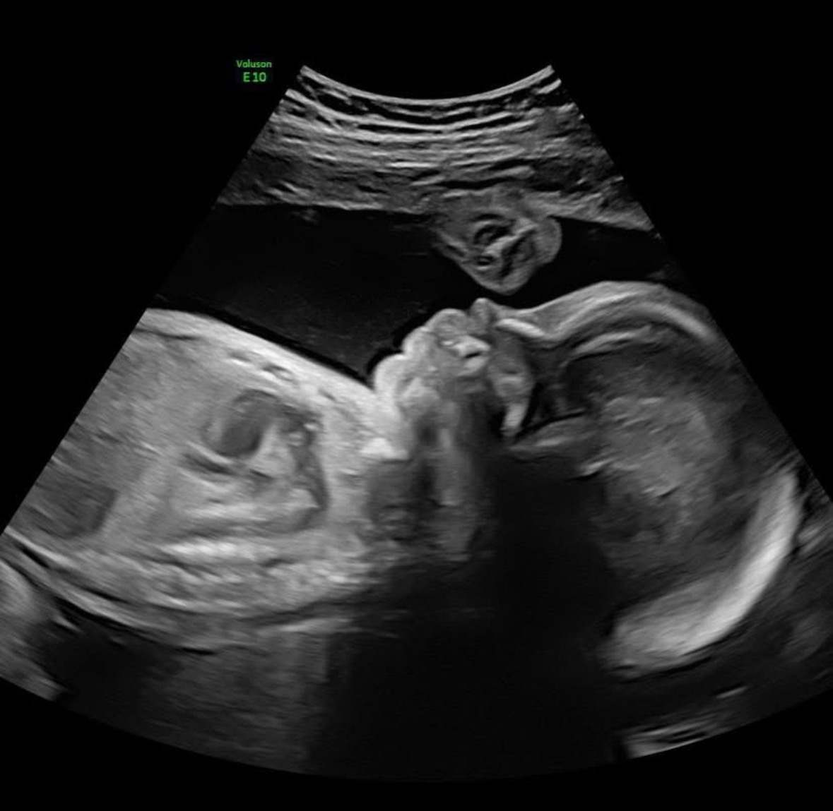 HLHS Warrior: Baby Brooks' Fund campaign photo, 5 of 6