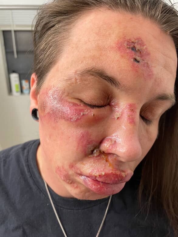 Recovering from being brutalized by police campaign photo, 7 of 8