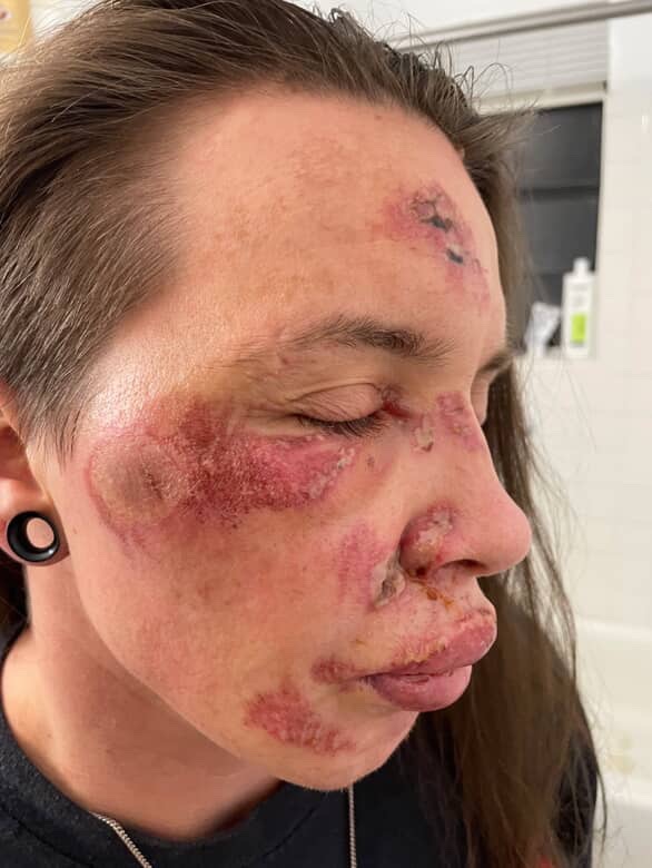 Recovering from being brutalized by police campaign photo, 2 of 8
