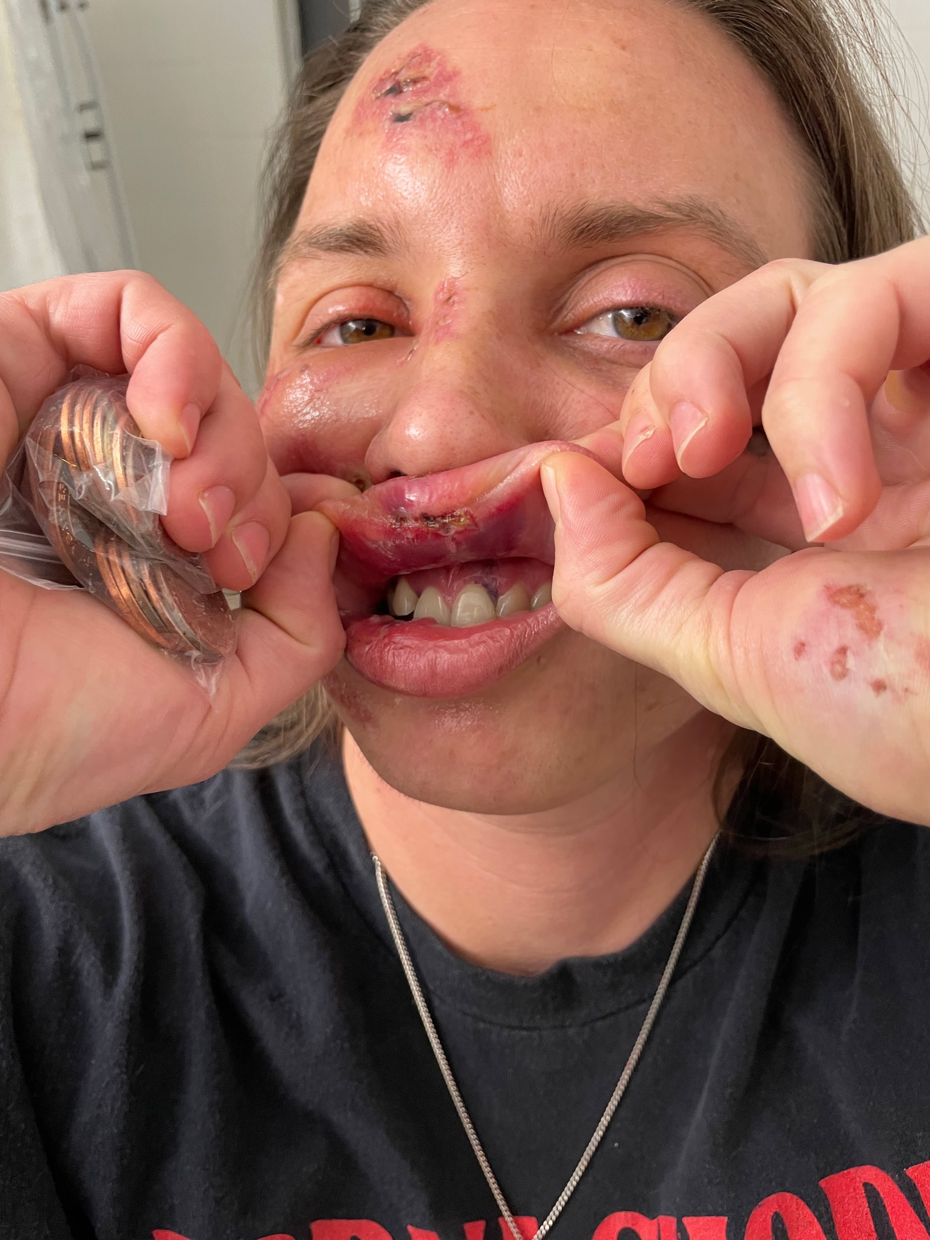 Recovering from being brutalized by police campaign photo, 4 of 8