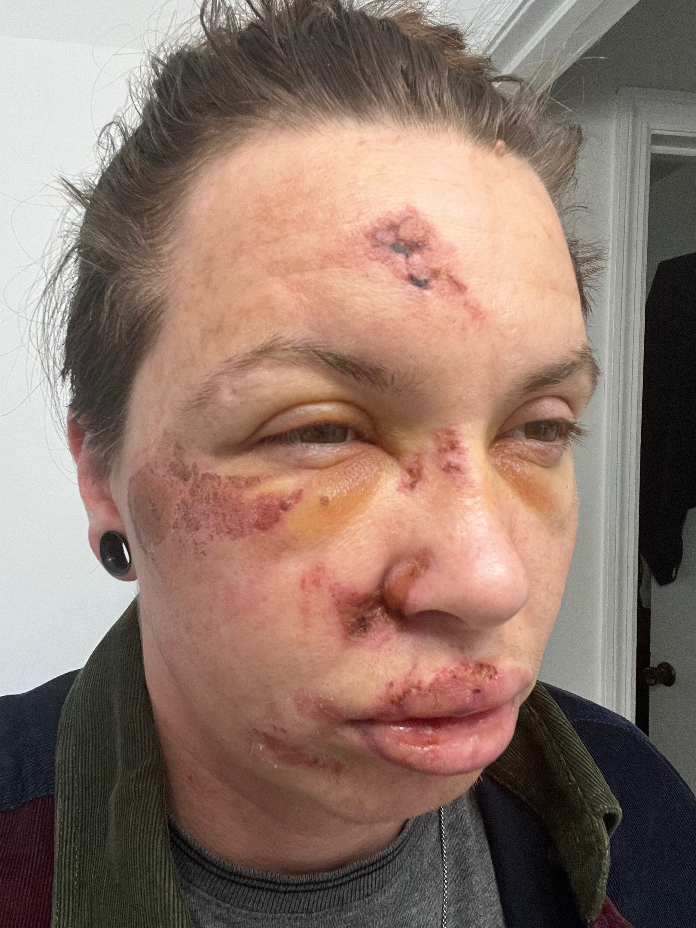 Recovering from being brutalized by police campaign photo, 5 of 8