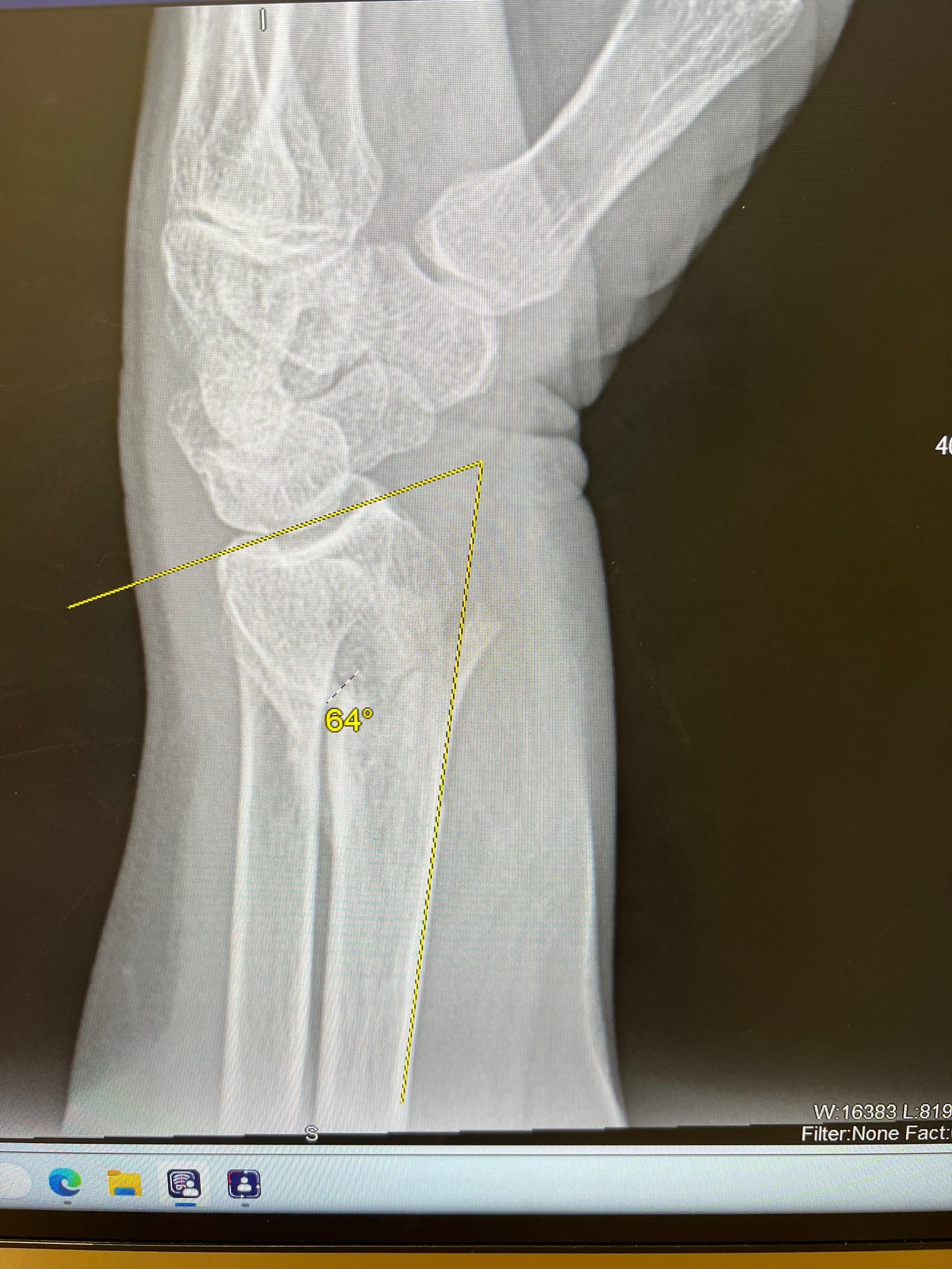 Rally for Mom's Wrist Surgery Costs campaign photo, 2 of 6