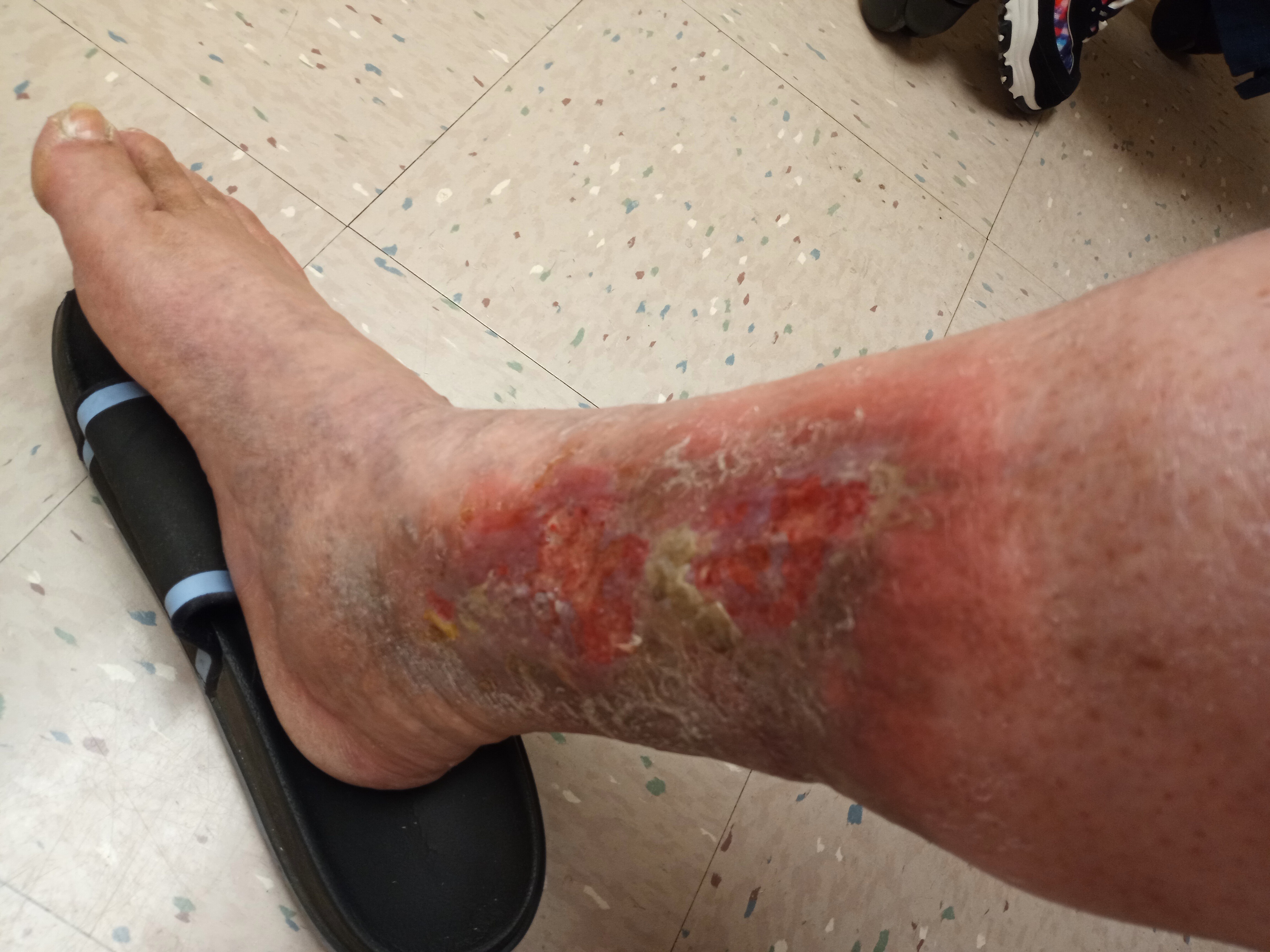 My family and I need your help to recover from my leg injury campaign photo, 4 of 5