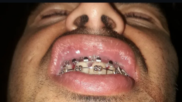 Help me, victim of assault, multiple maxillofacial fracture photo