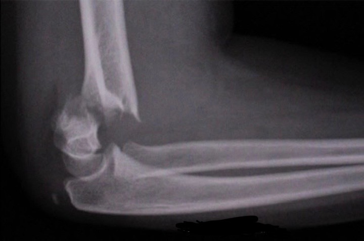 Broken Arm campaign photo, 2 of 4