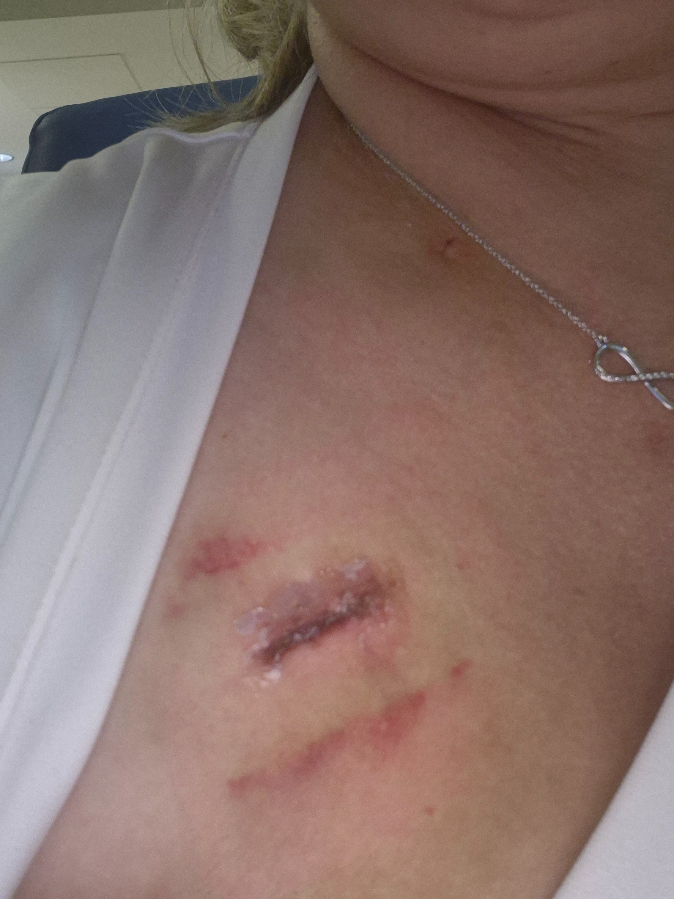 Please help me beat St 3 Aggressive TNBC w 5 lymph node meta campaign photo, 7 of 8