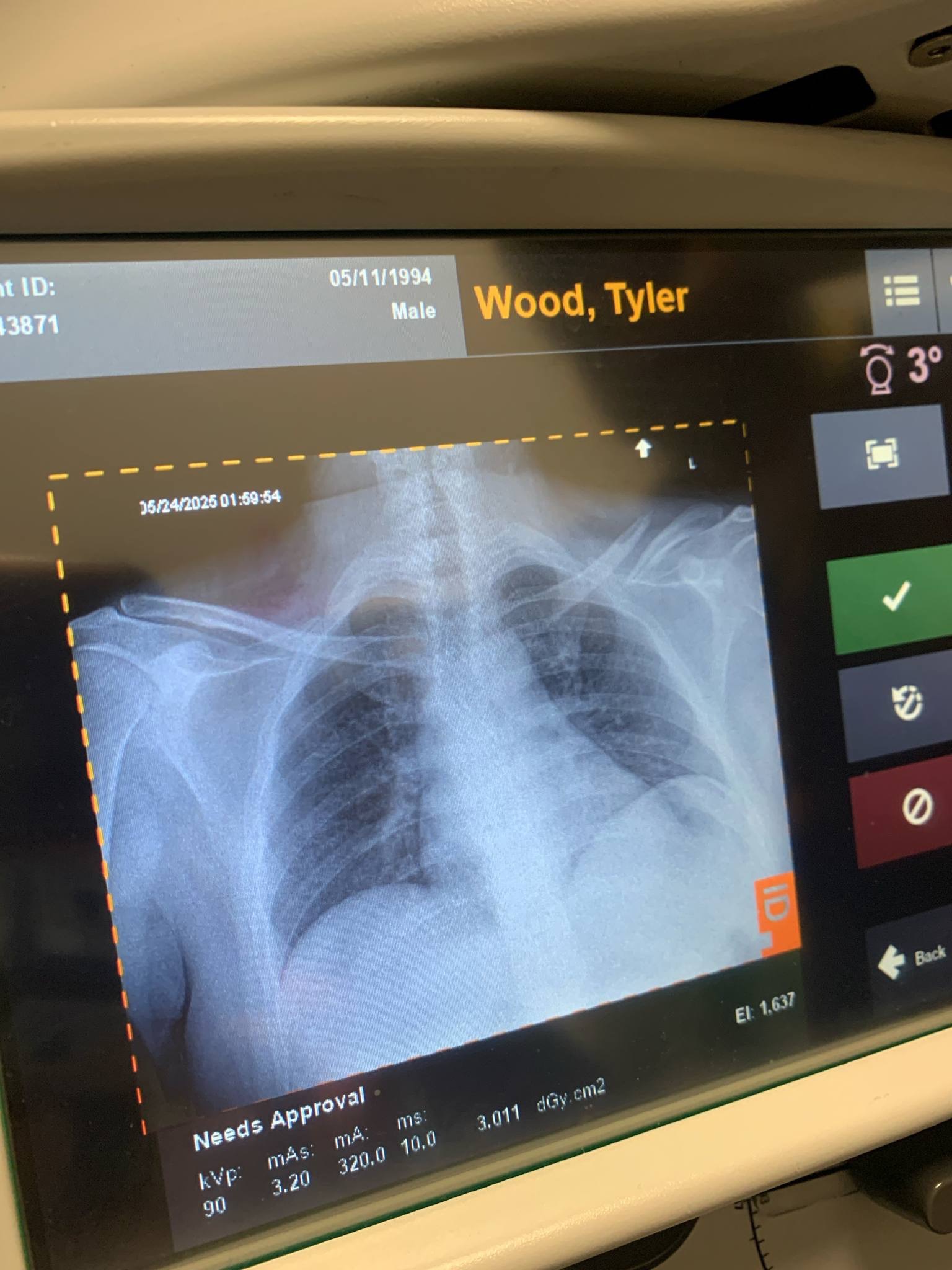 Tyler Broke His Collarbone and Needs Some Help campaign photo, 2 of 8