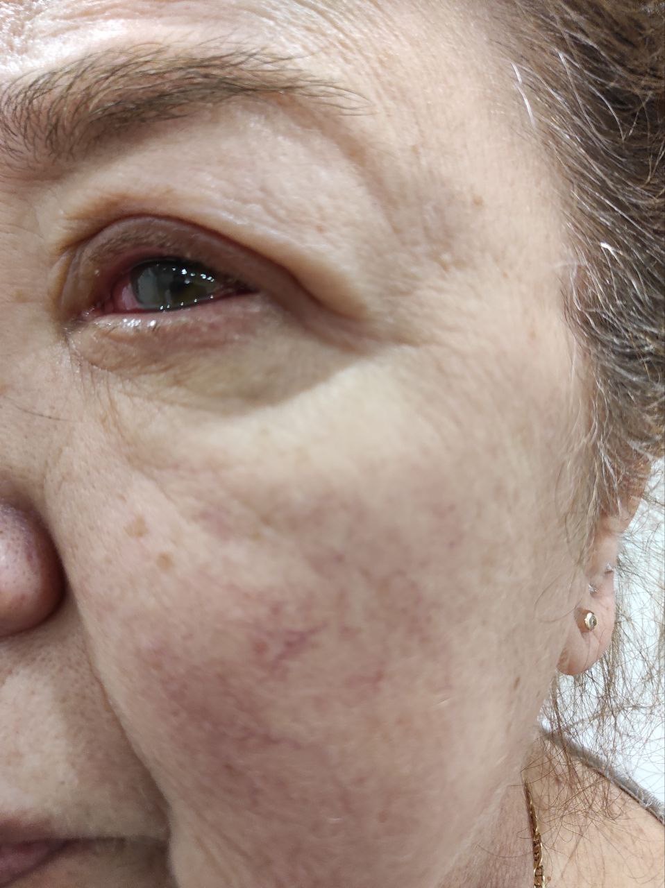 Help to save my mom’s eye, she needs a surgery in Ukraine. campaign photo, 4 of 8
