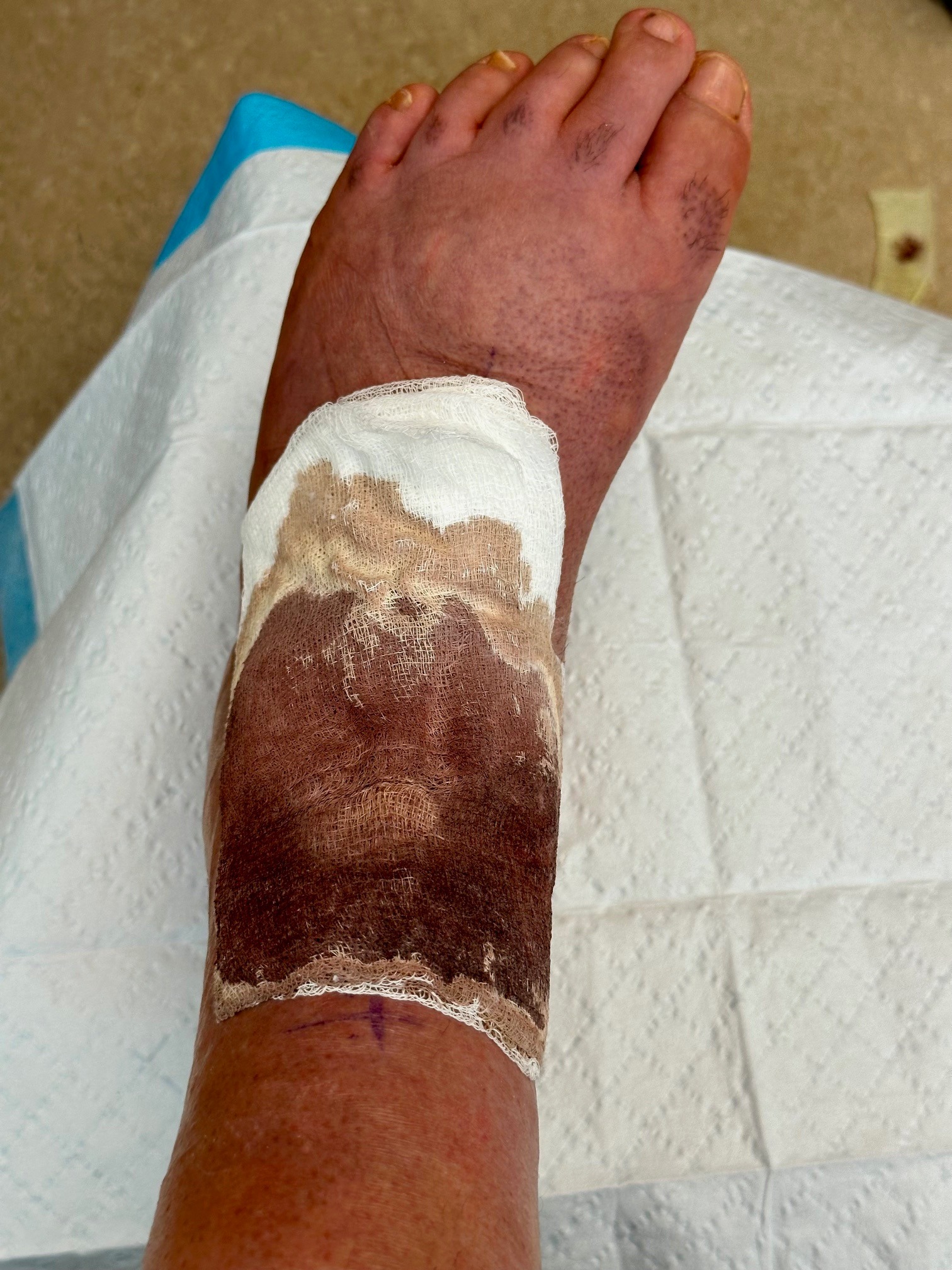 Michael's Urgent Medical Expense Help for his Arthrogryposis campaign photo, 2 of 8
