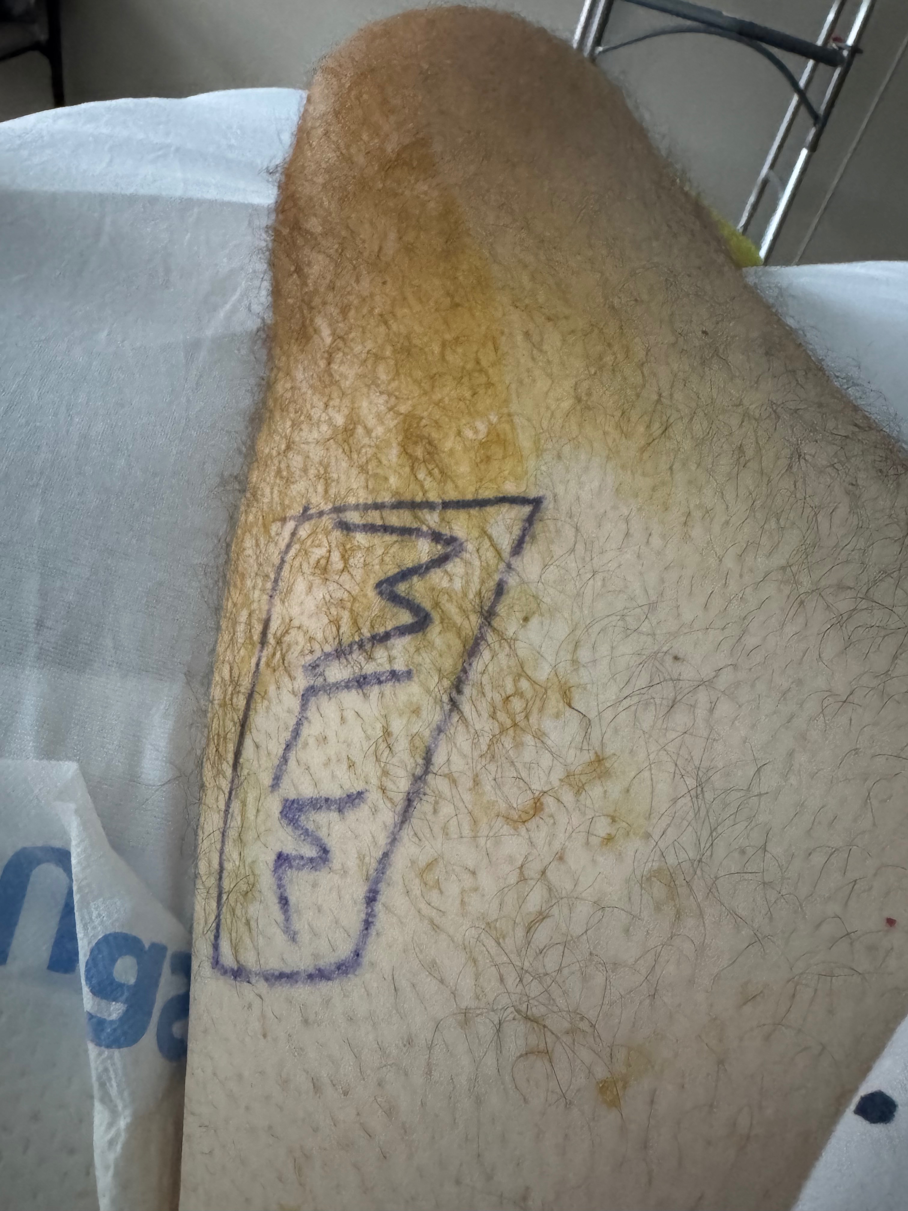 Support Tom's Recovery from Amputation & Broken Hip Surgery campaign photo, 4 of 6