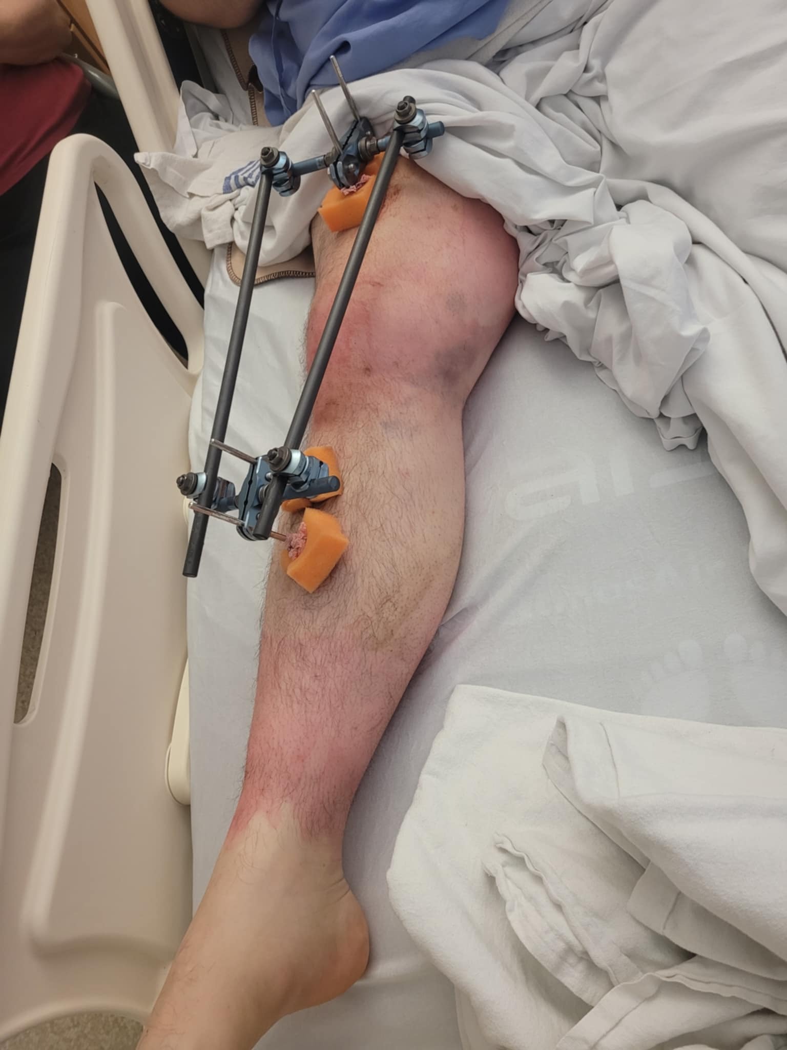 Will's medical expenses, loss of income, physio,impound fees campaign photo, 5 of 7