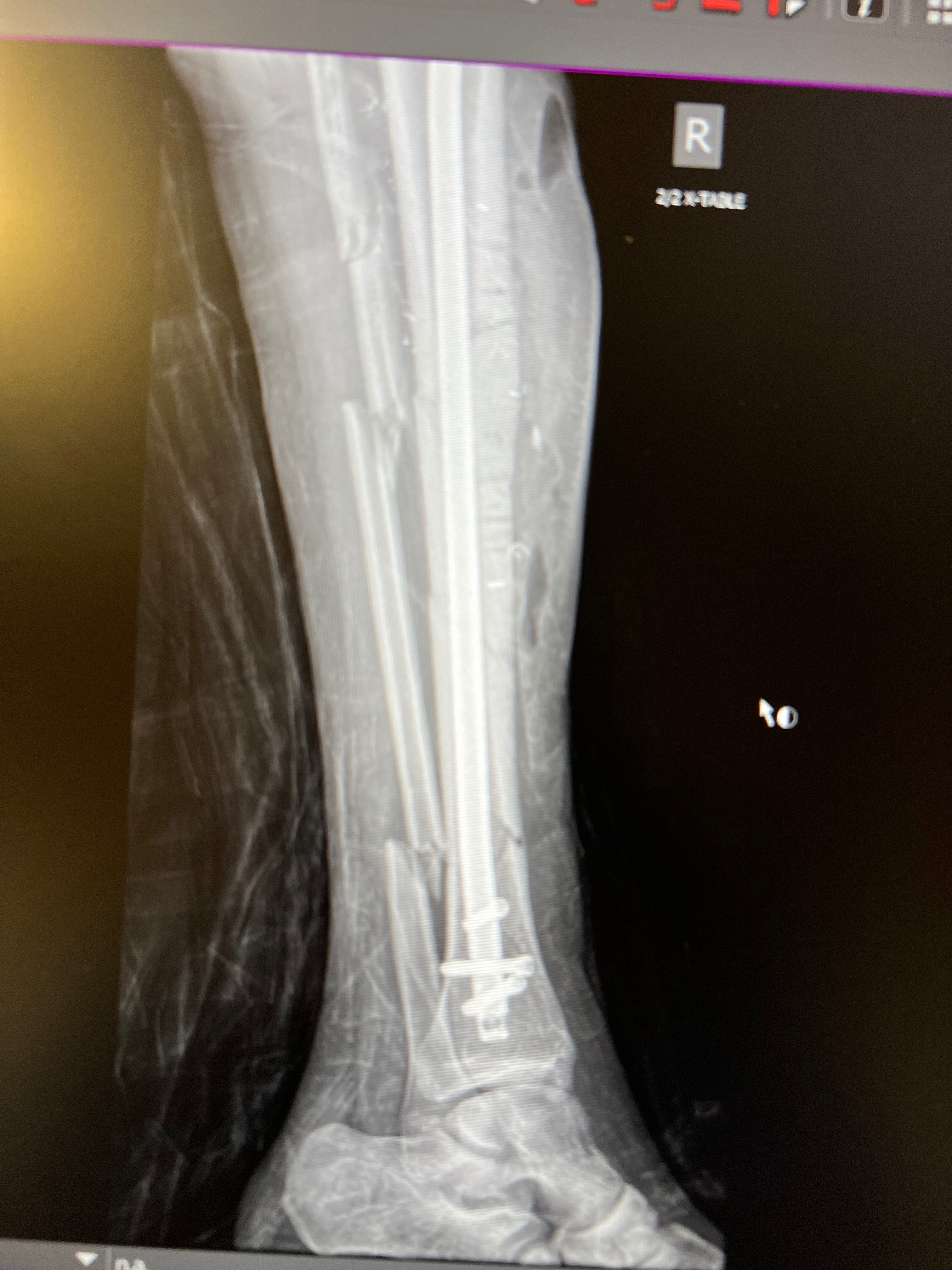 Help Brandon Heal After Devastating Accident campaign photo, 4 of 8