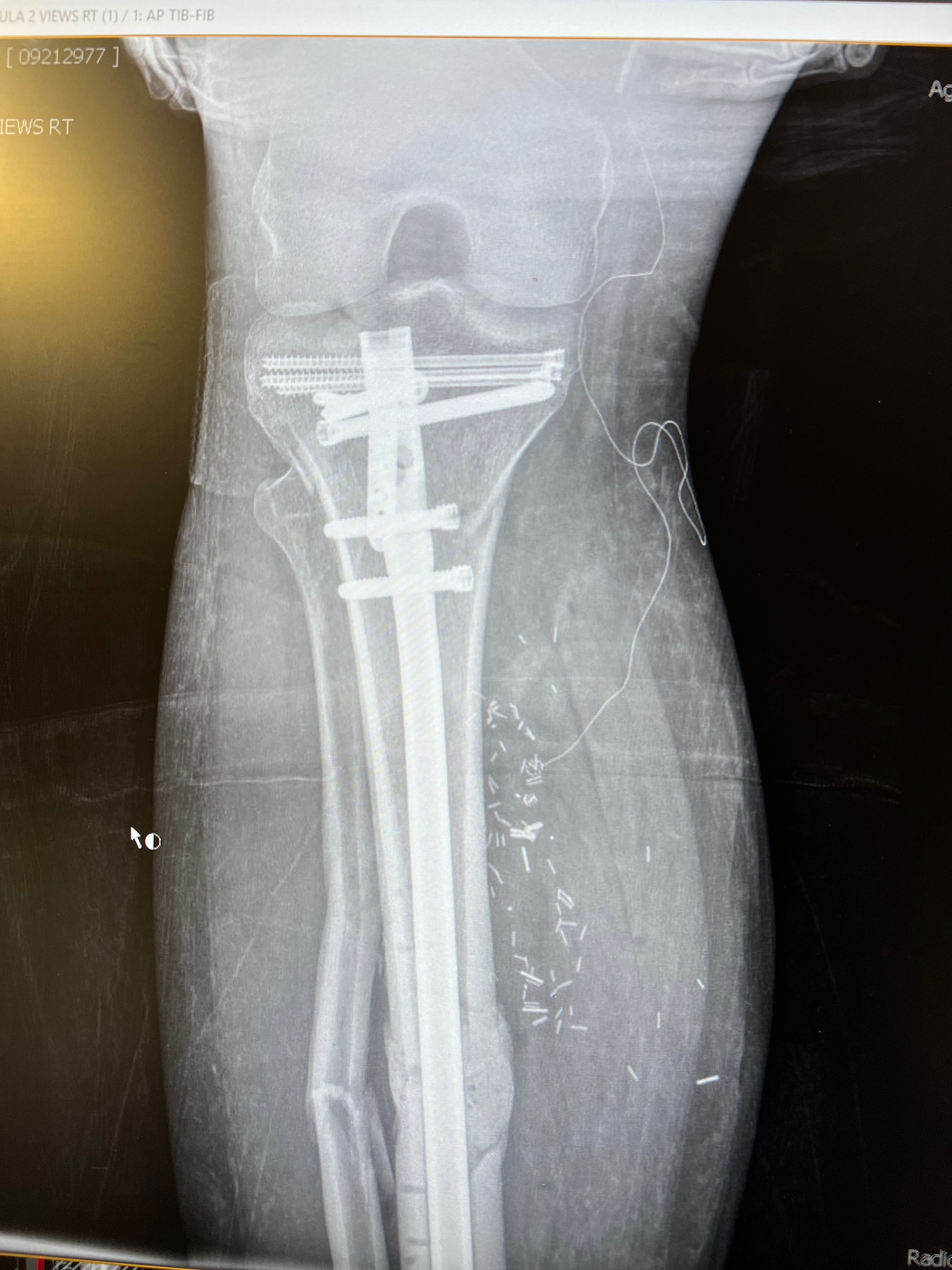 Help Brandon Heal After Devastating Accident campaign photo, 2 of 8