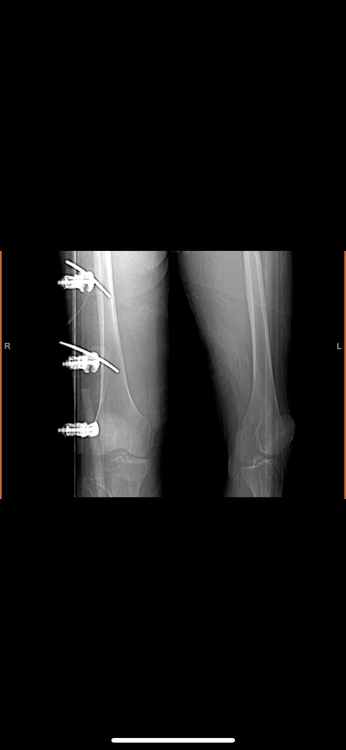 Aid Brandon After His Severe Leg Break campaign photo, 2 of 7