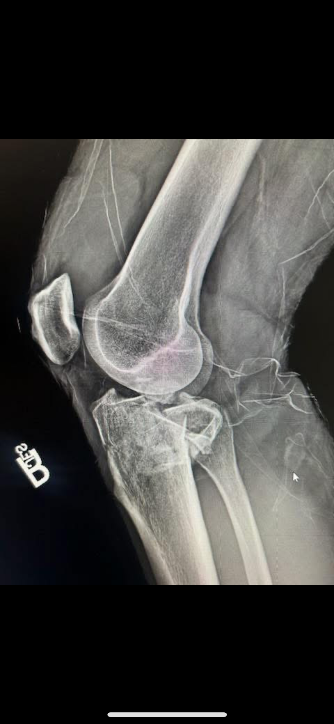Aid Brandon After His Severe Leg Break campaign photo, 4 of 7