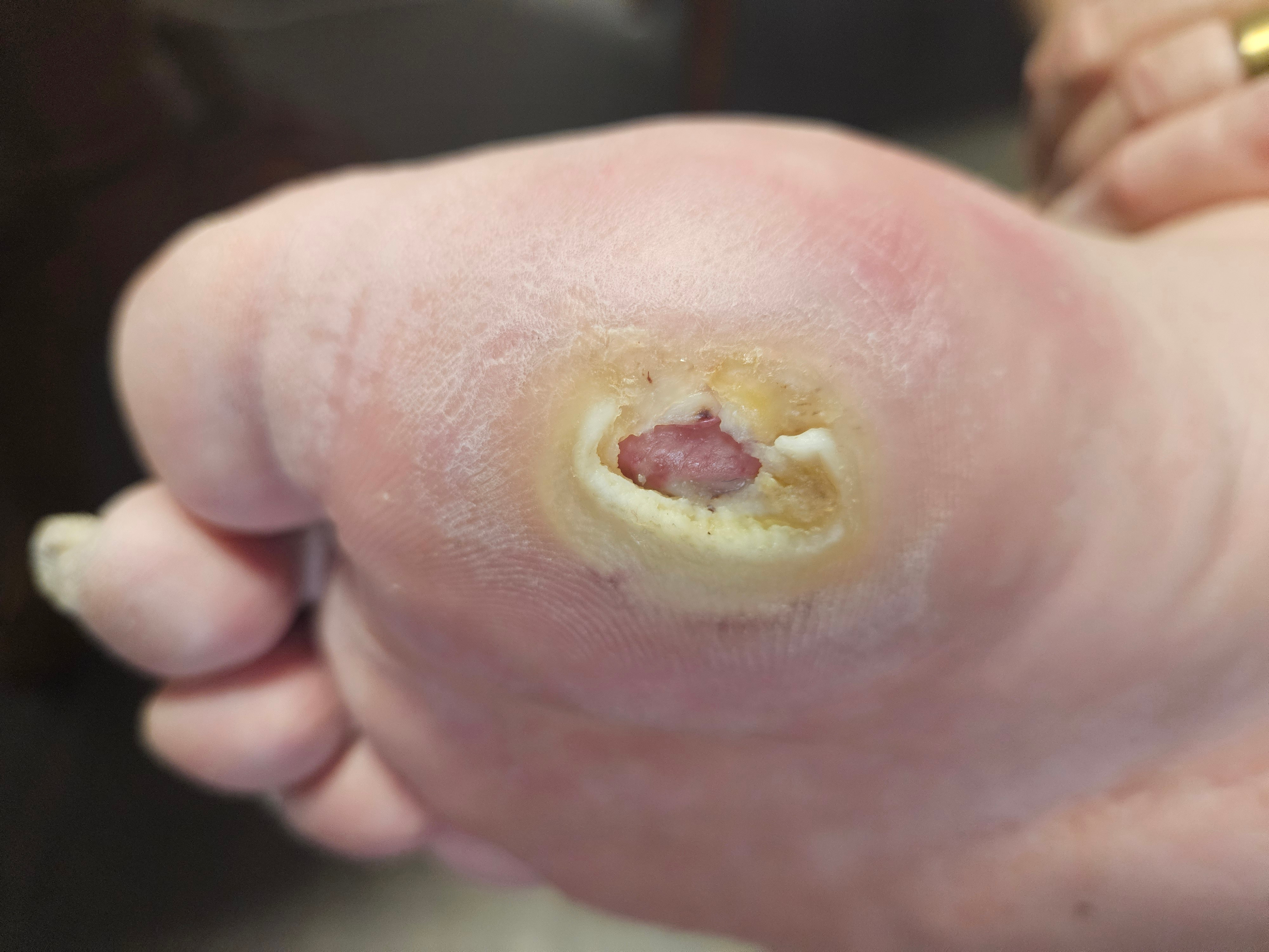 Donate to Help Phil Anderson Avoid Amputation campaign photo, 2 of 6