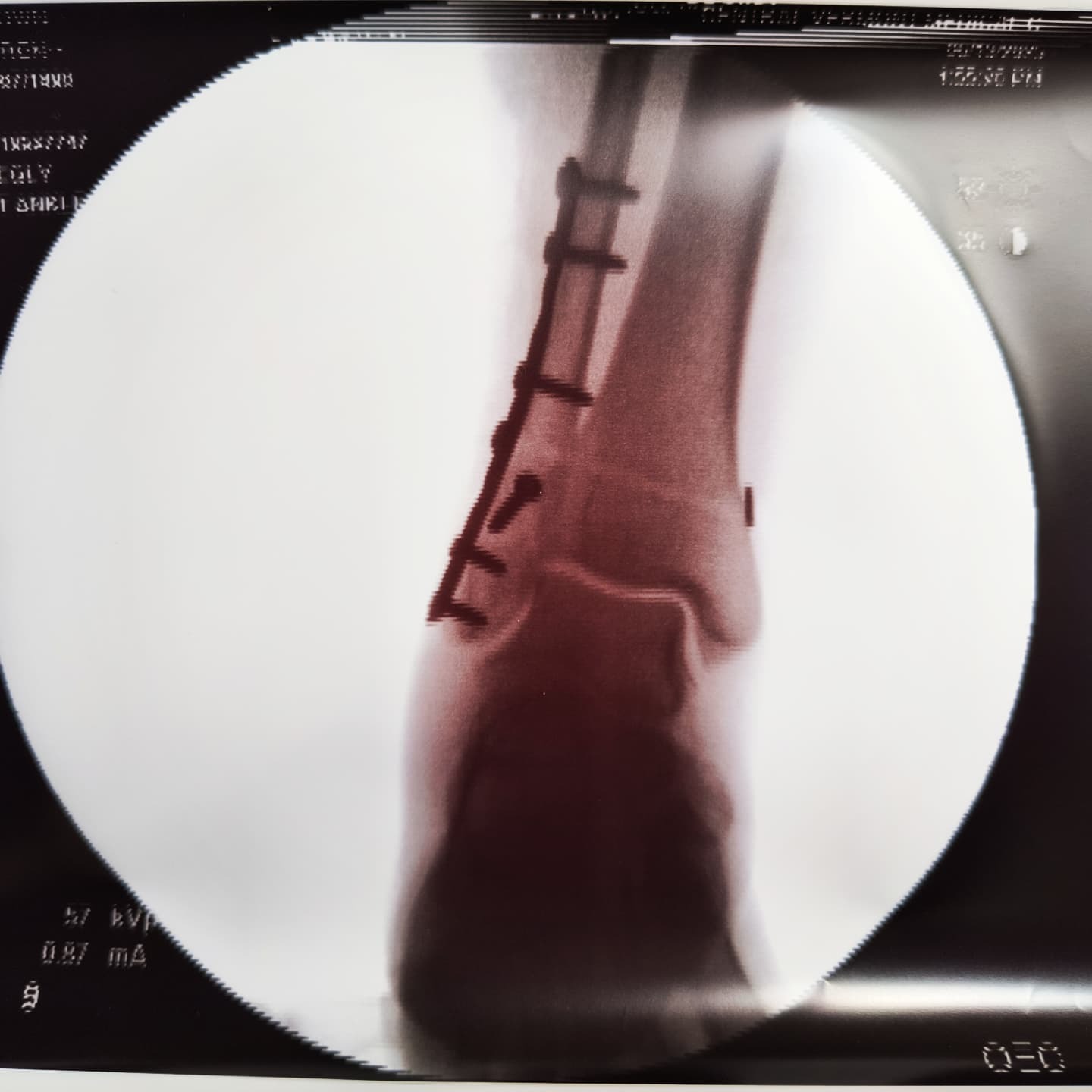 Support the Swamp Hag after ankle surgery! campaign photo, 2 of 7