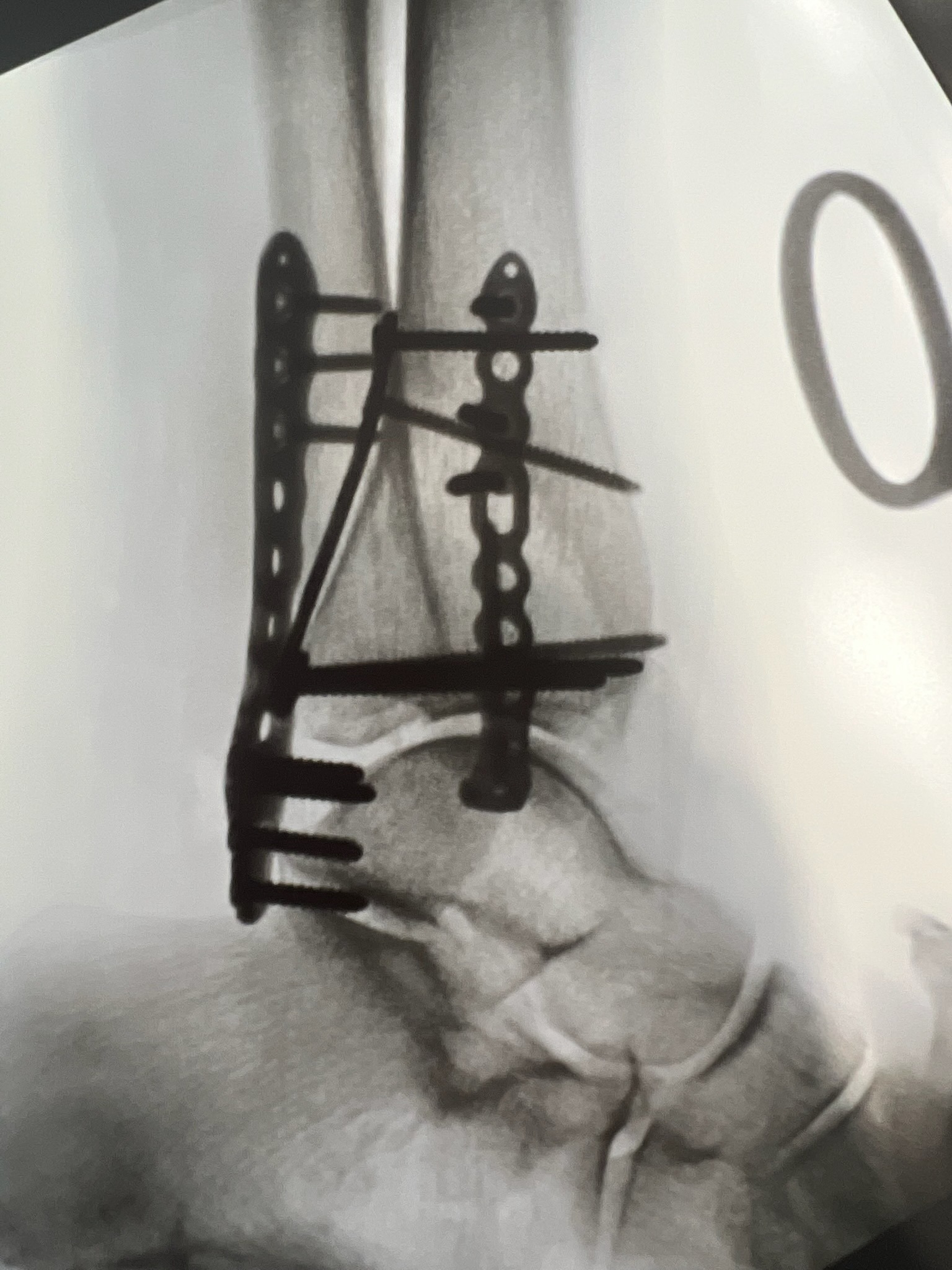 Kelene Needs Your Help for Her Ankle Recovery campaign photo, 4 of 5