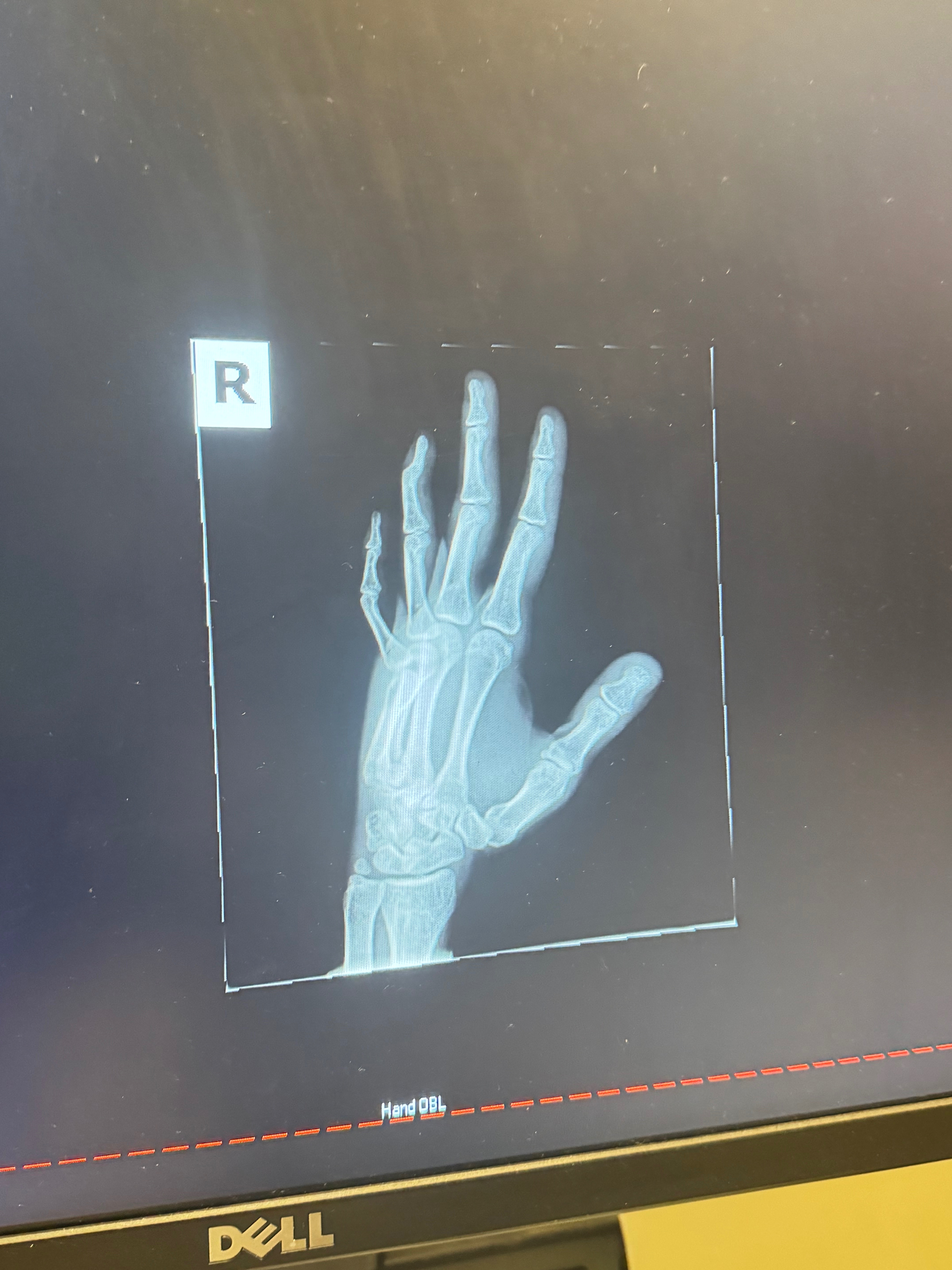 Emergency Surgery Fund for Mary’s hand campaign photo, 6 of 7