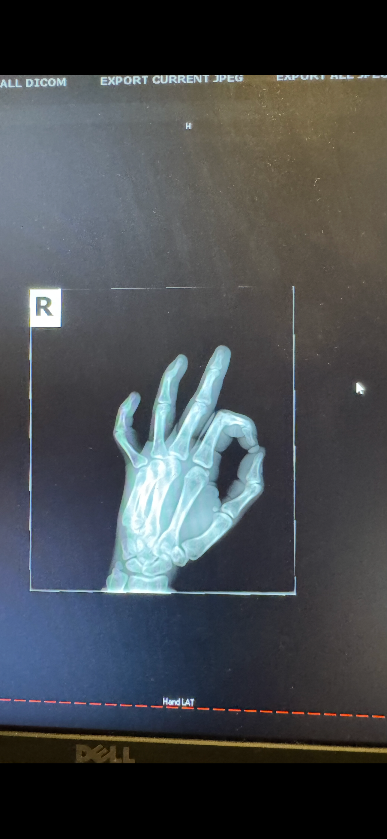 Emergency Surgery Fund for Mary’s hand campaign photo, 2 of 7