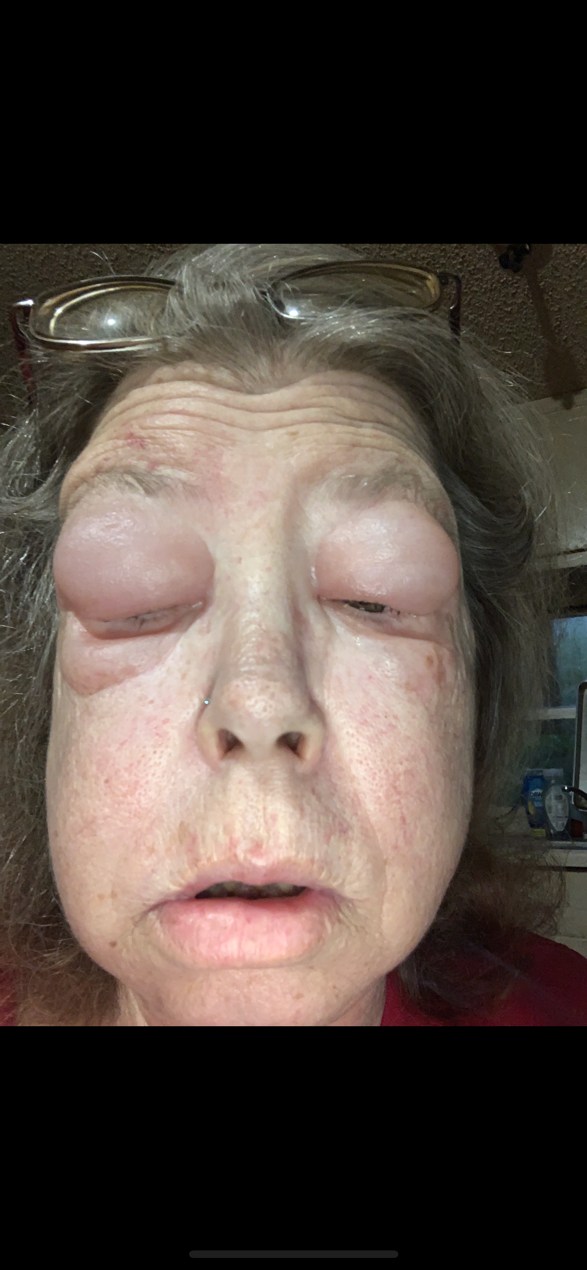 Donate for Cataract Surgery Recovery campaign photo, 2 of 4