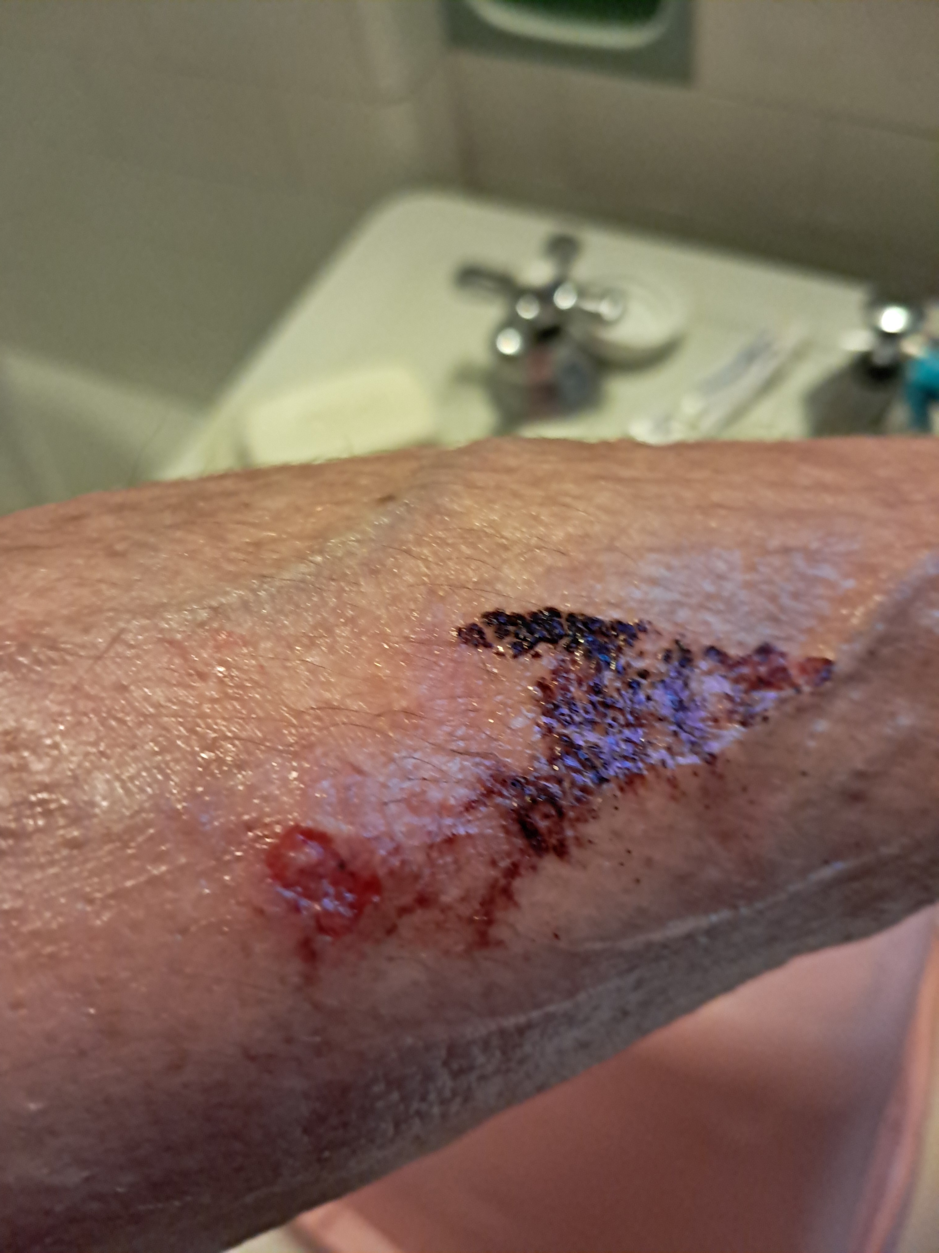 Support Hope Solly's Fight Against Tunga penetrant campaign photo, 5 of 5