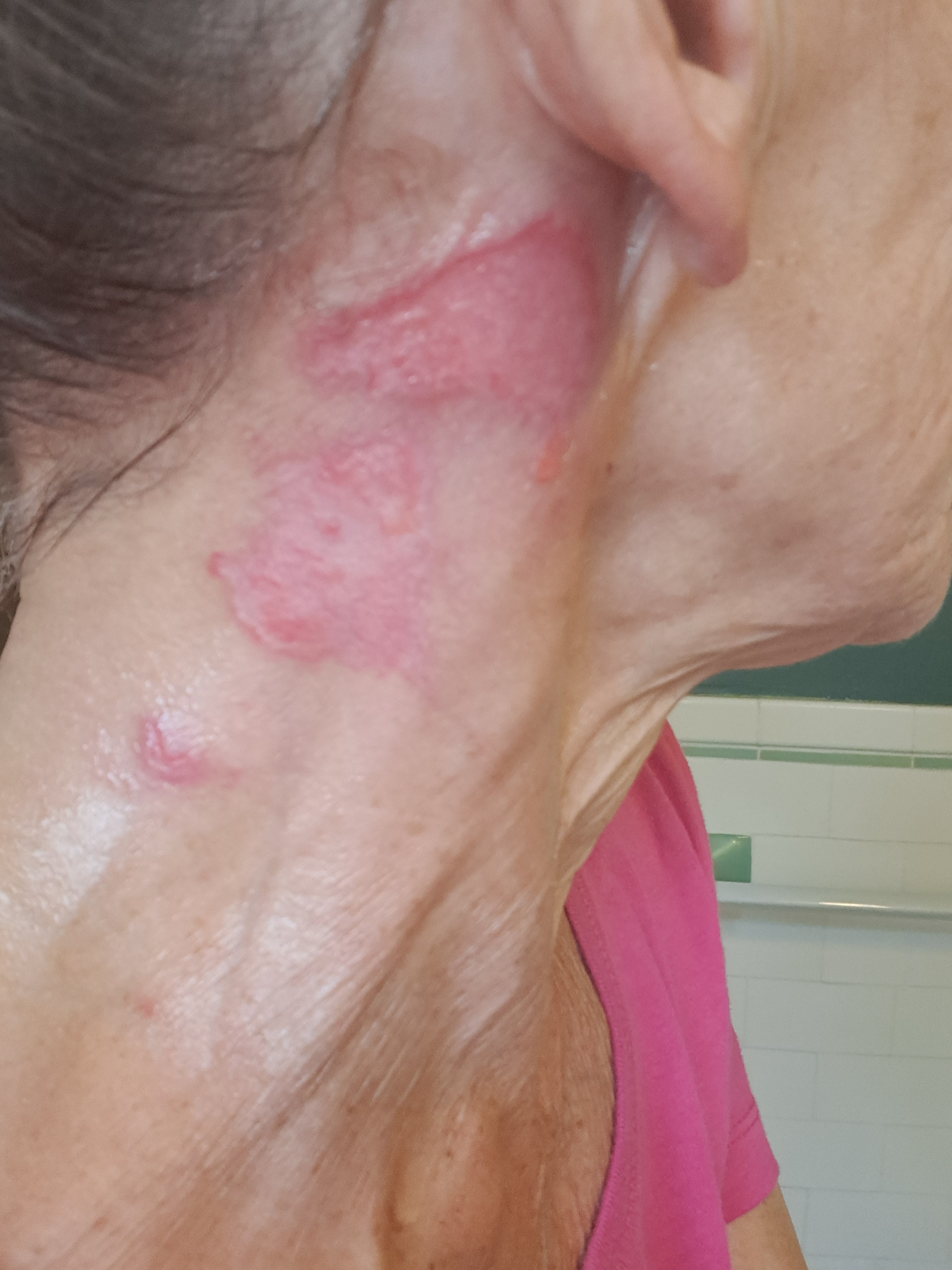 Support Hope Solly's Fight Against Tunga penetrant campaign photo, 1 of 5