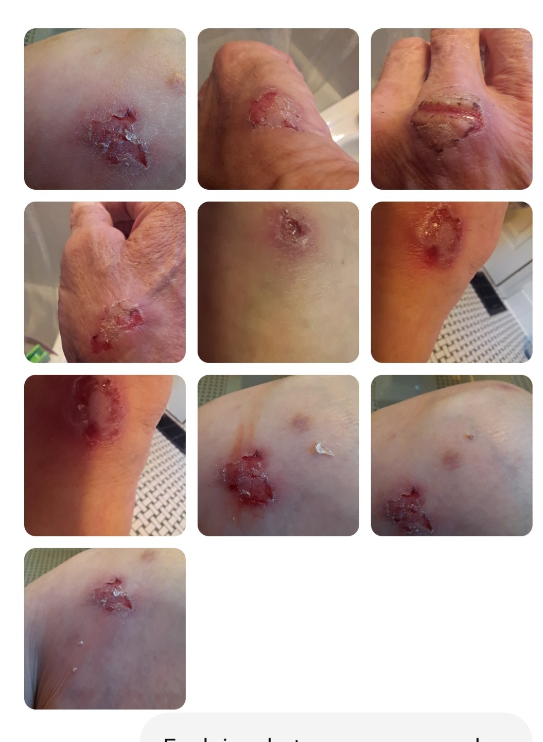 Support Hope Solly's Fight Against Tunga penetrant campaign photo, 4 of 5