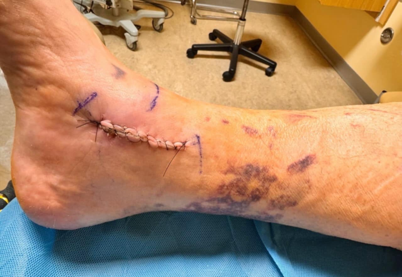 Help Torrey Recover from Domestic Assault Gofundme