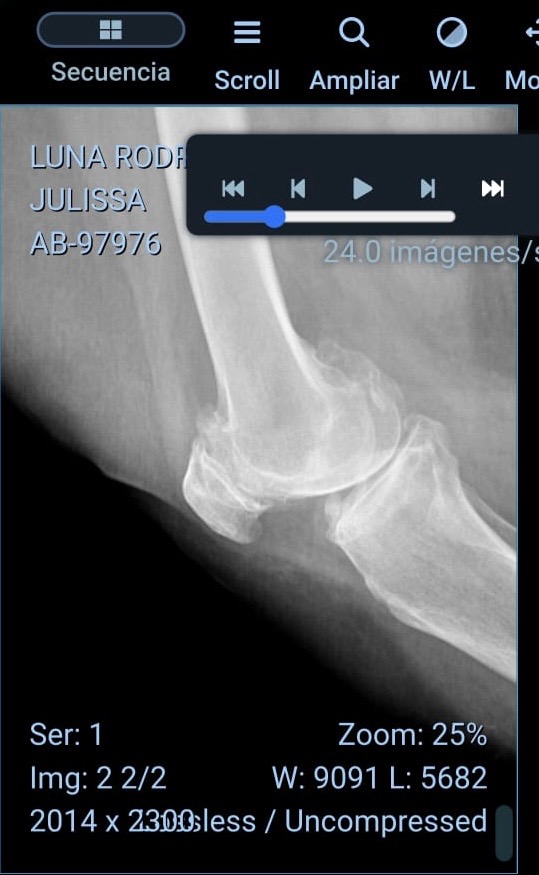 Cirugía de rodilla para Julissa: necesita nuestra ayuda