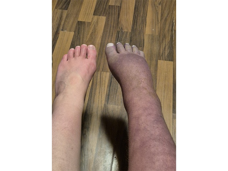 Leonie braucht Deine Hilfe! CRPS hat Ihr Leben verändert! campaign photo, 6 of 7
