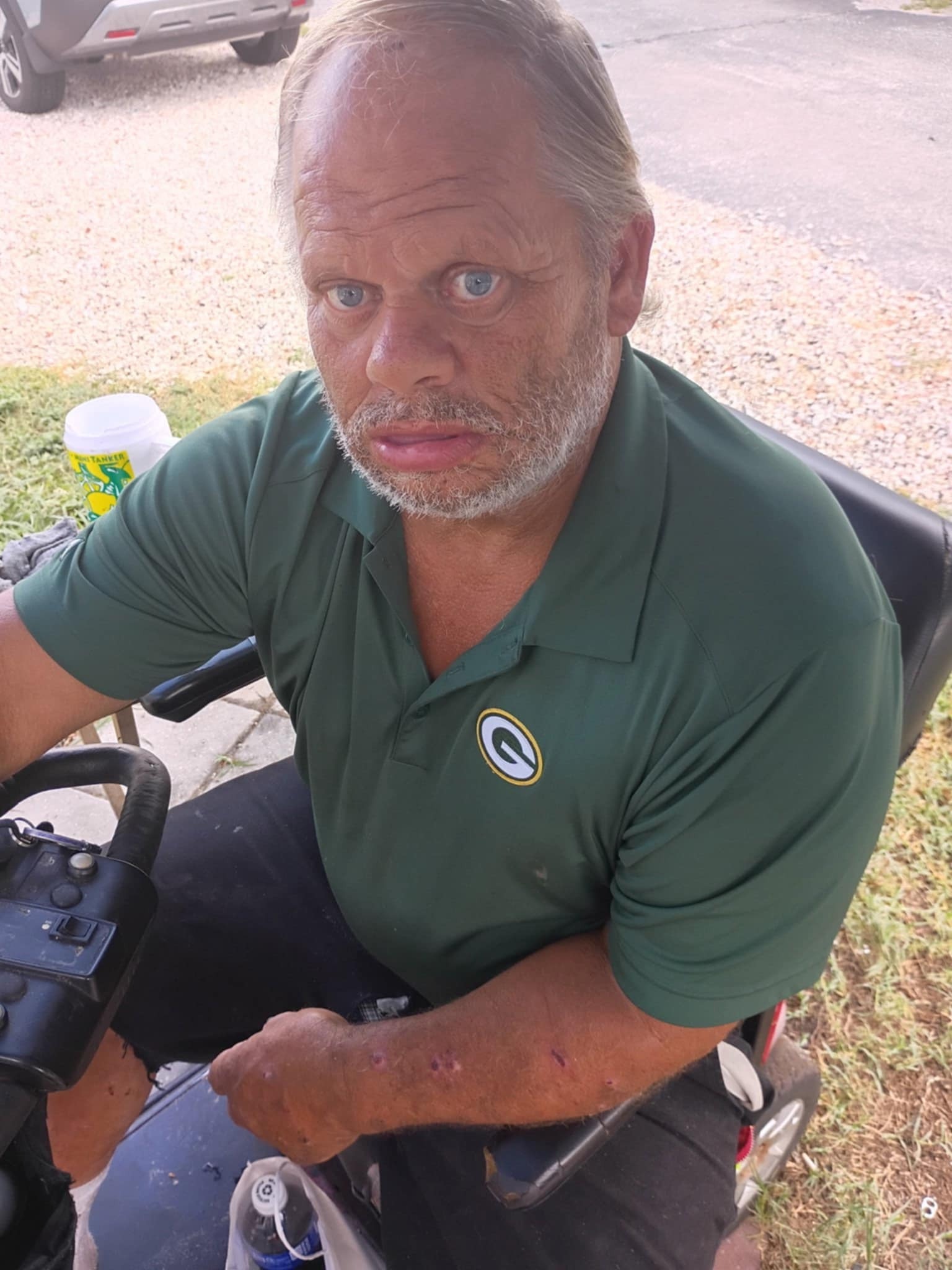 Donate to Eddy's Life-Changing Surgery campaign photo, 2 of 4