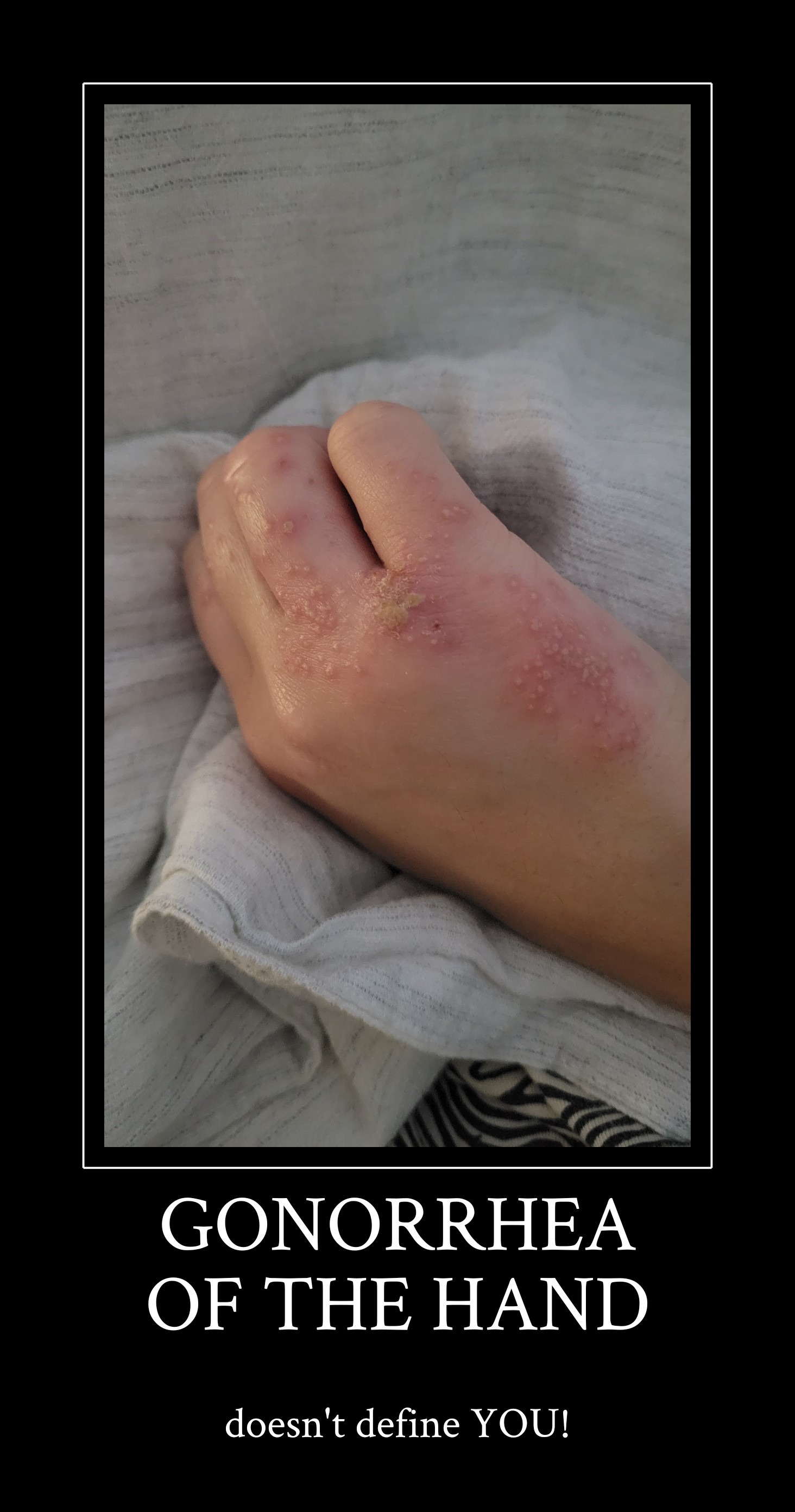 Support Neko’s Battle Against Hand Gonorrhea Gofundme