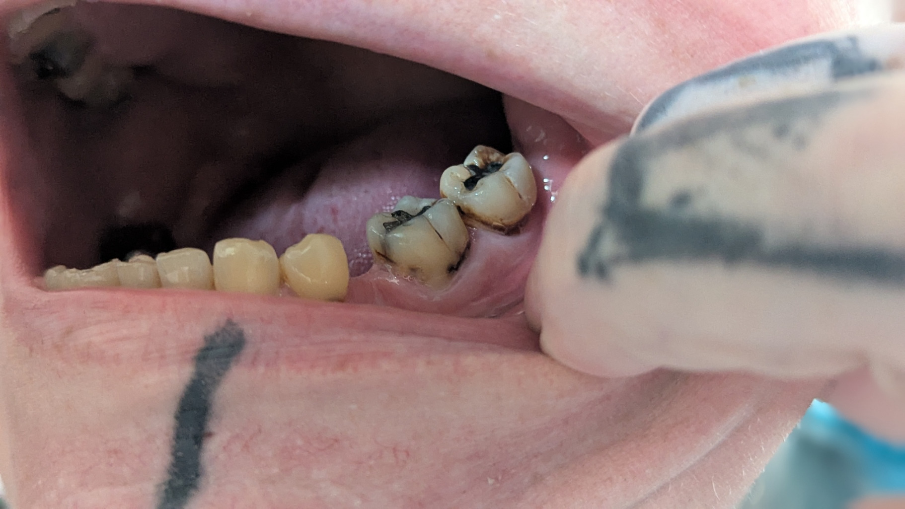 Decay To Dentures campaign photo, 4 of 7