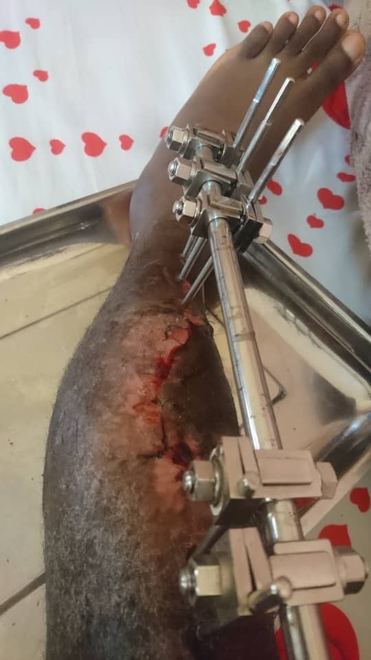Sauvons la vie a Wilfried souffrant d'ostéomyélite chronique campaign photo, 2 of 8