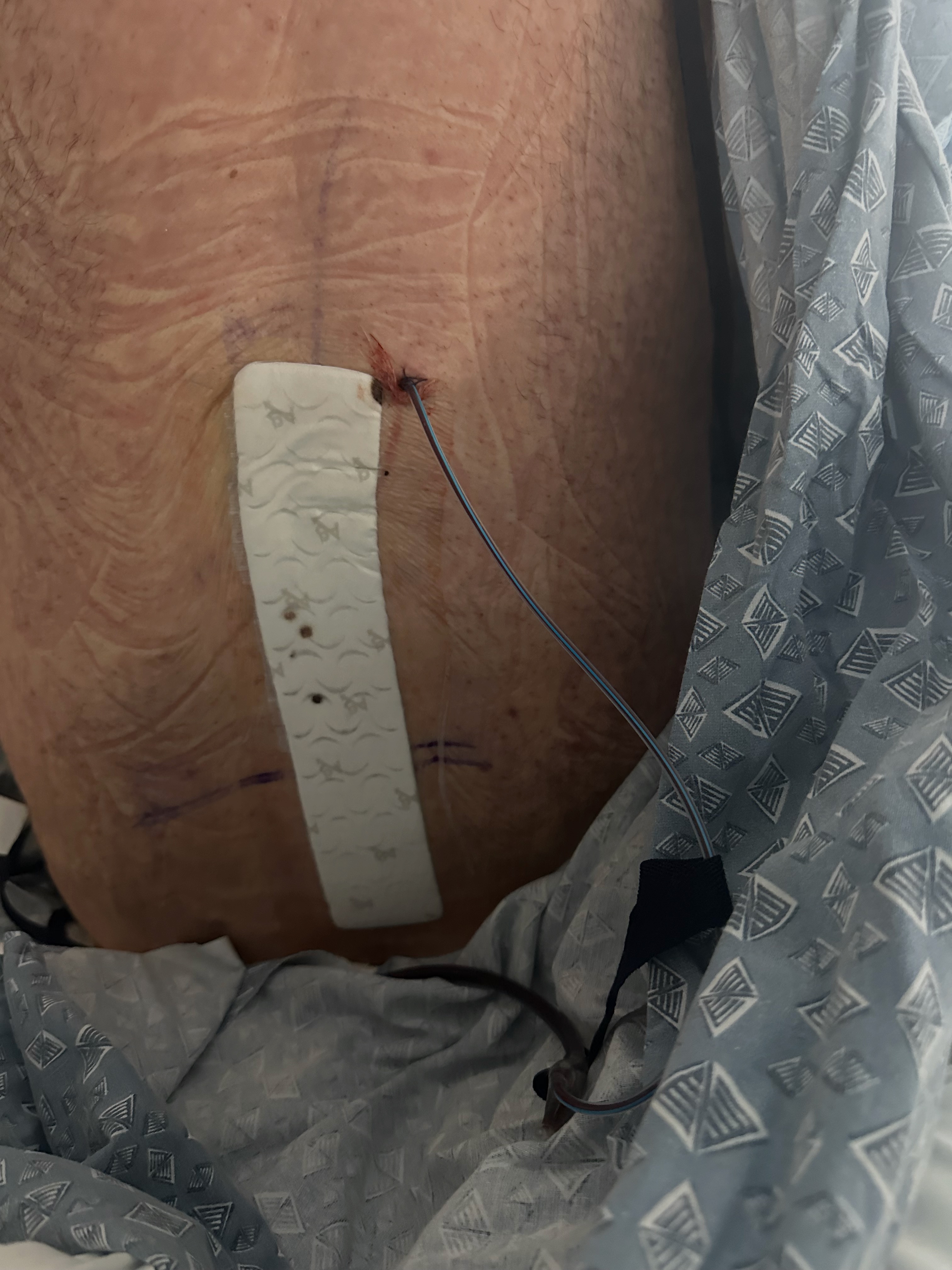 Donate to Erick Soares Spine Fusion Surgery Recovery Journey campaign photo, 5 of 7