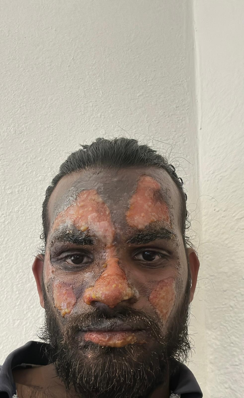 Help Srinivasarao Recover from Fire Accident campaign photo, 5 of 5
