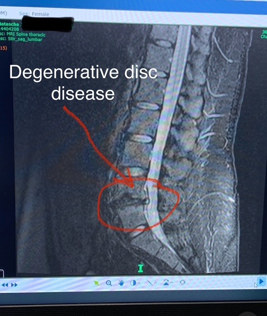 20 Years of Pain & Misdiagnosis—Spinal Surgery Can Save Me campaign photo, 6 of 8